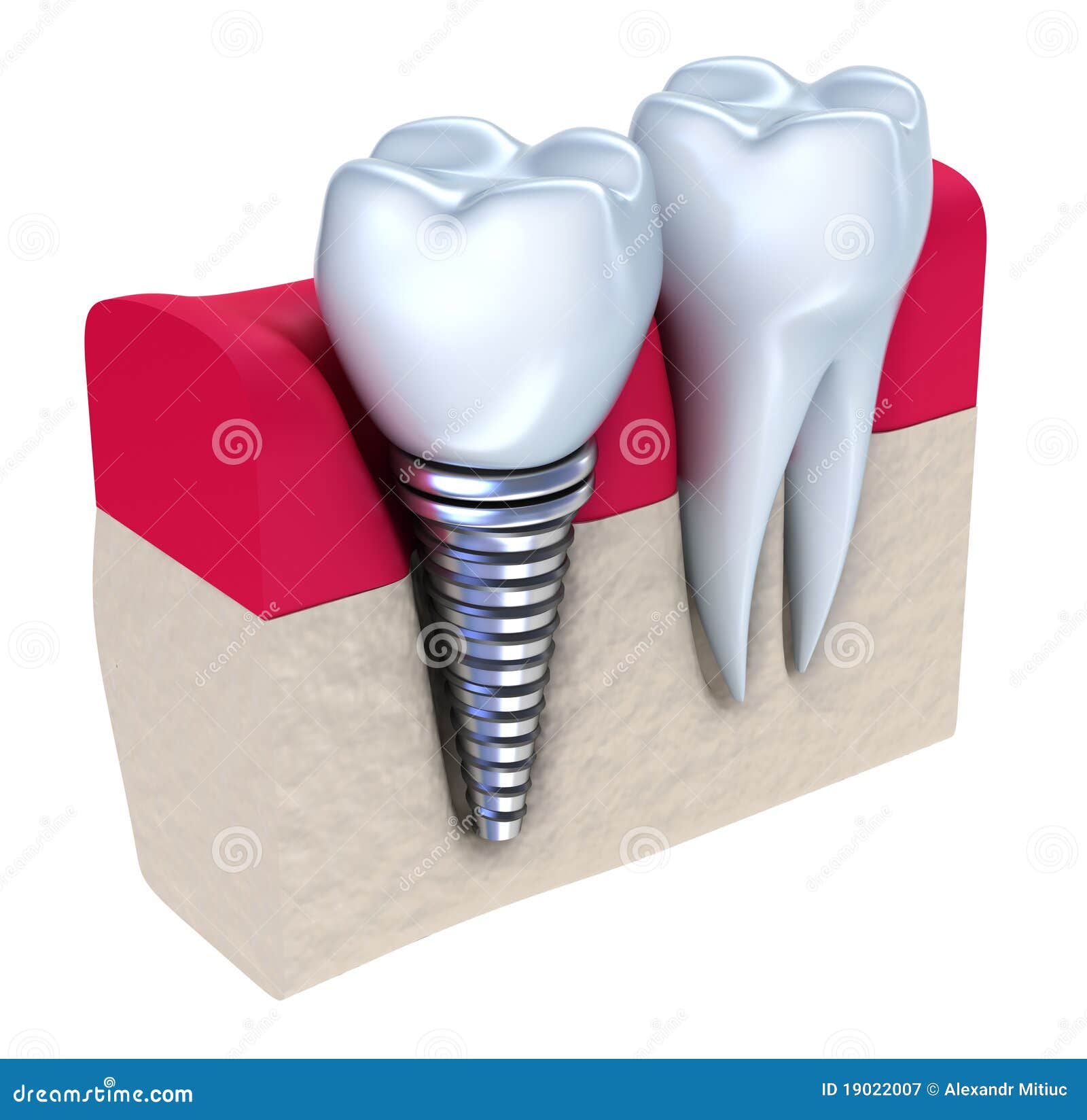Dental Implant Implanted in Jaw Bone Stock Illustration
