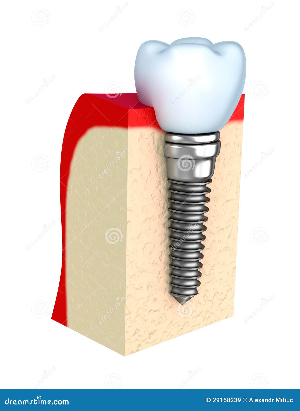 Dental implant in jaw bone stock illustration. Illustration of embed
