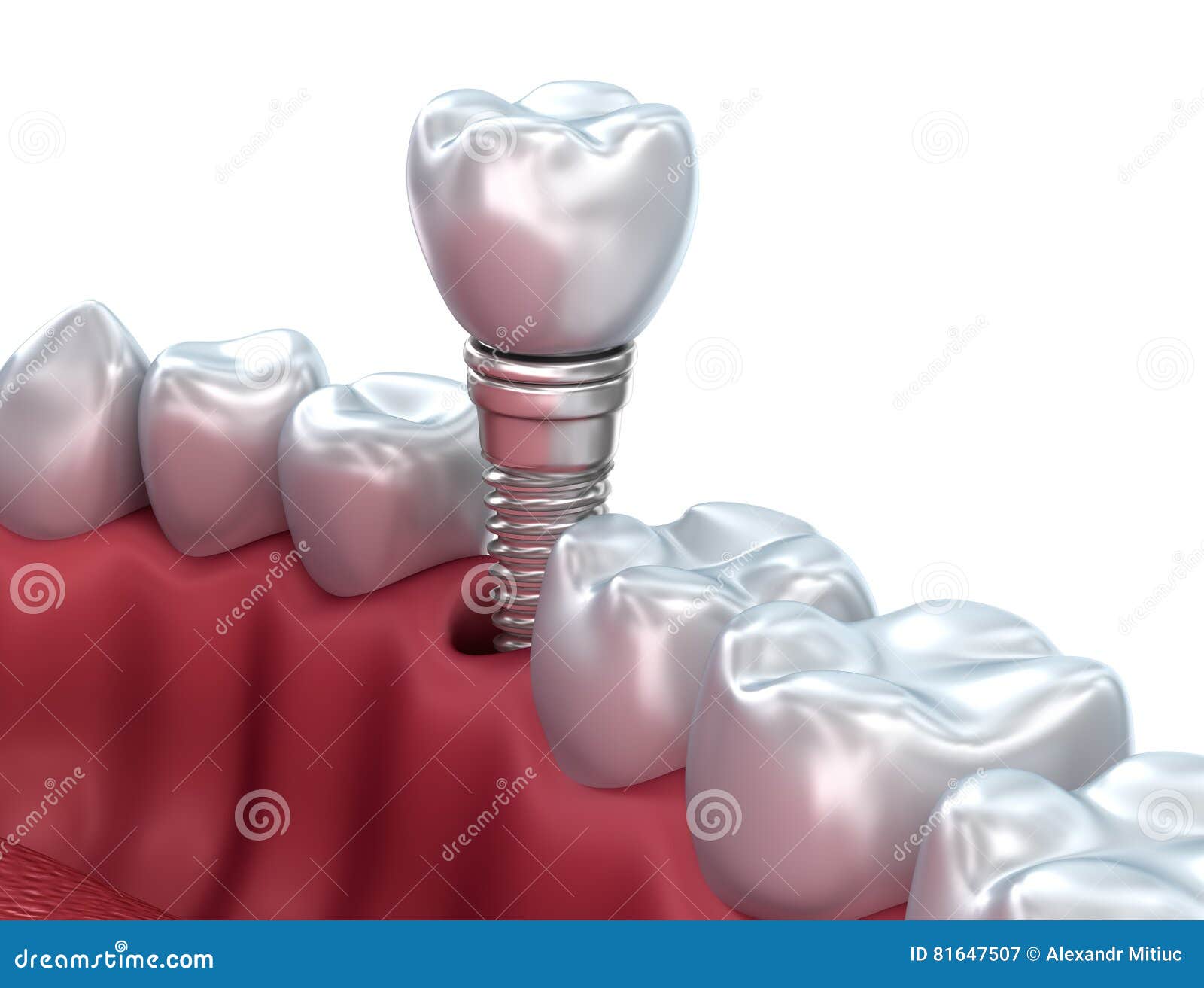 Dental Implant, Medically Accurate Stock Illustration Illustration of