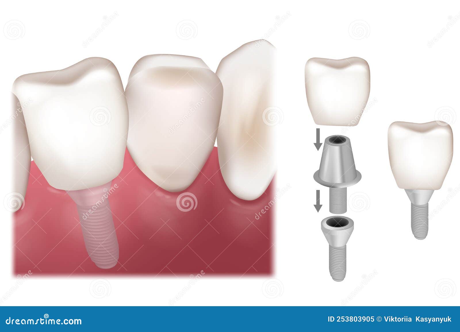 Dental Implant Recovery. Premolar Tooth Crown Installation Over Implant