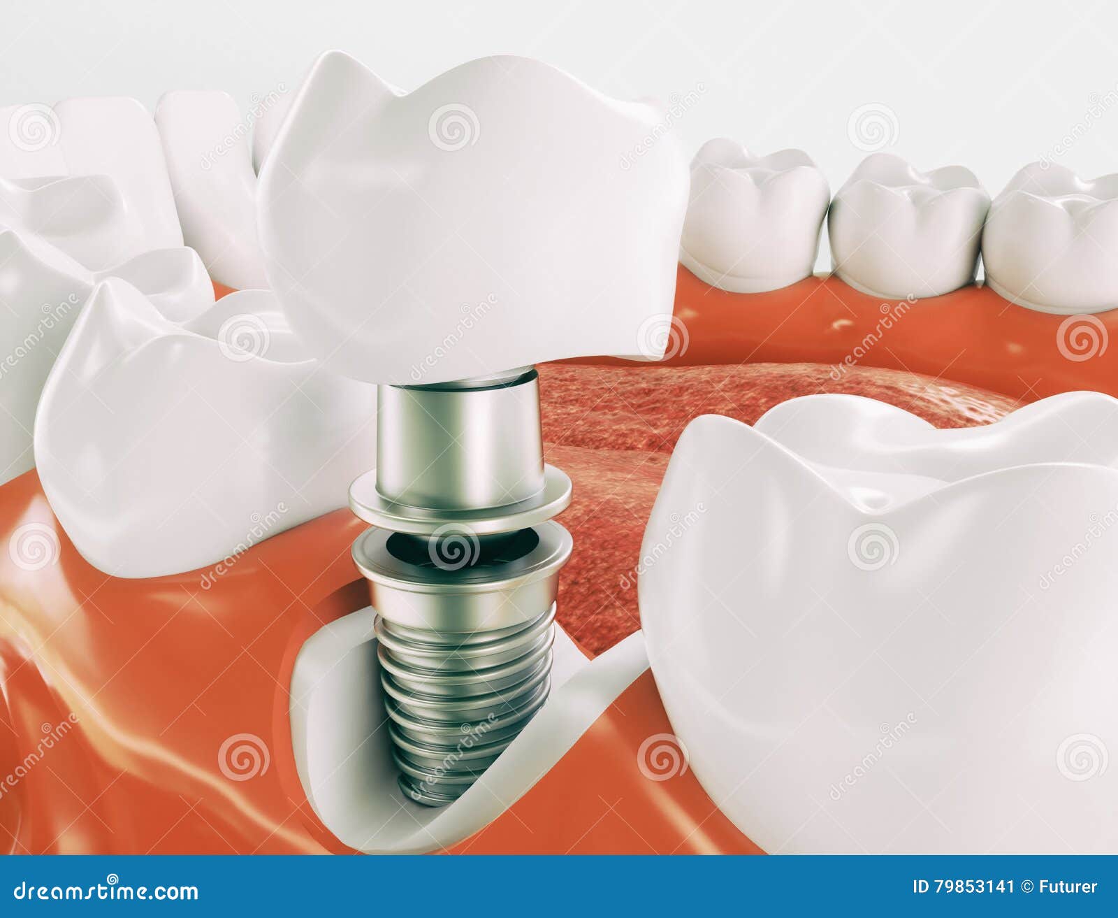 dental implant - series 2 of 3 - 3d rendering