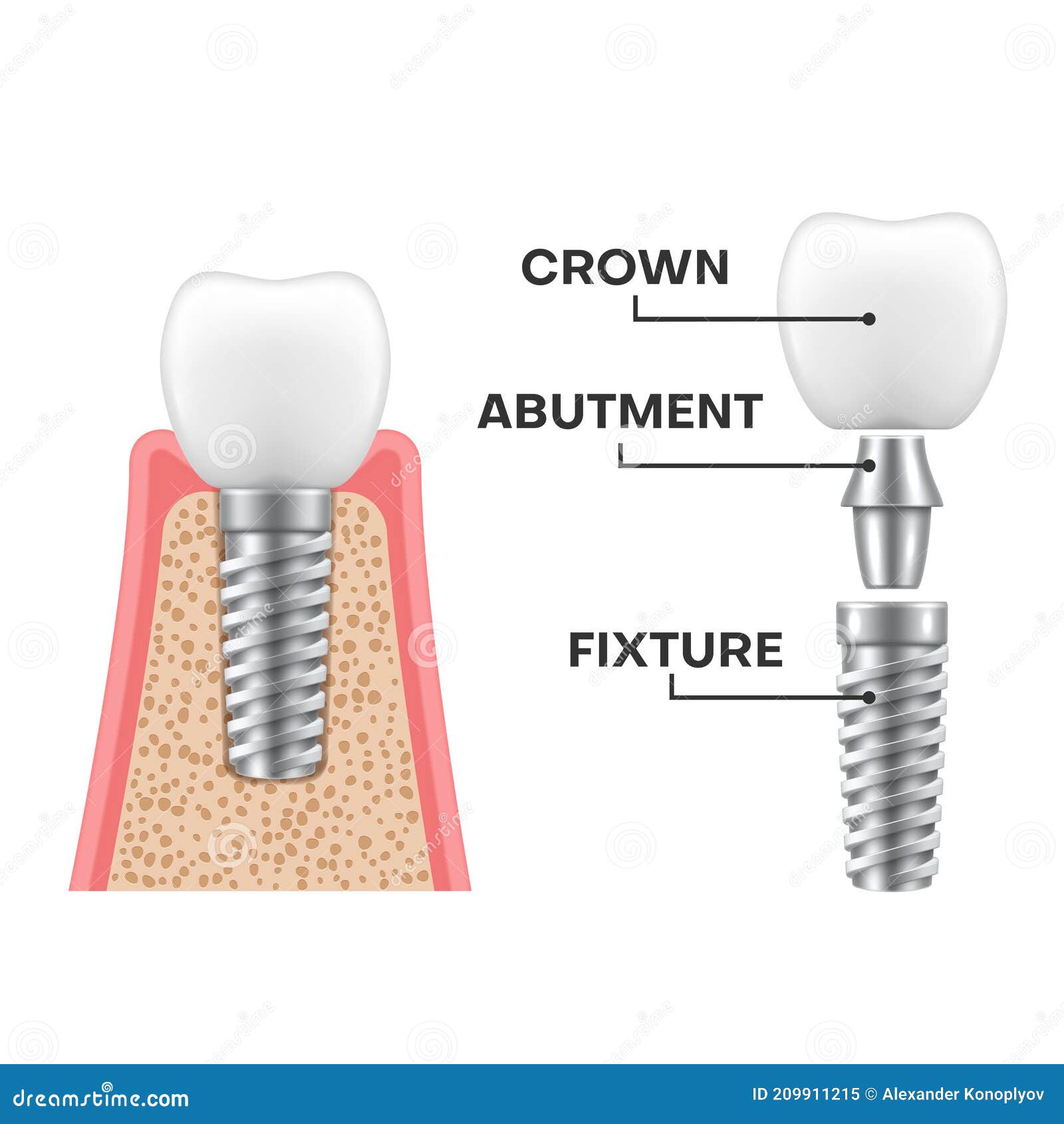 dental implant structure realistic schematic. implantation sequence. fixture, abutment, crown.
