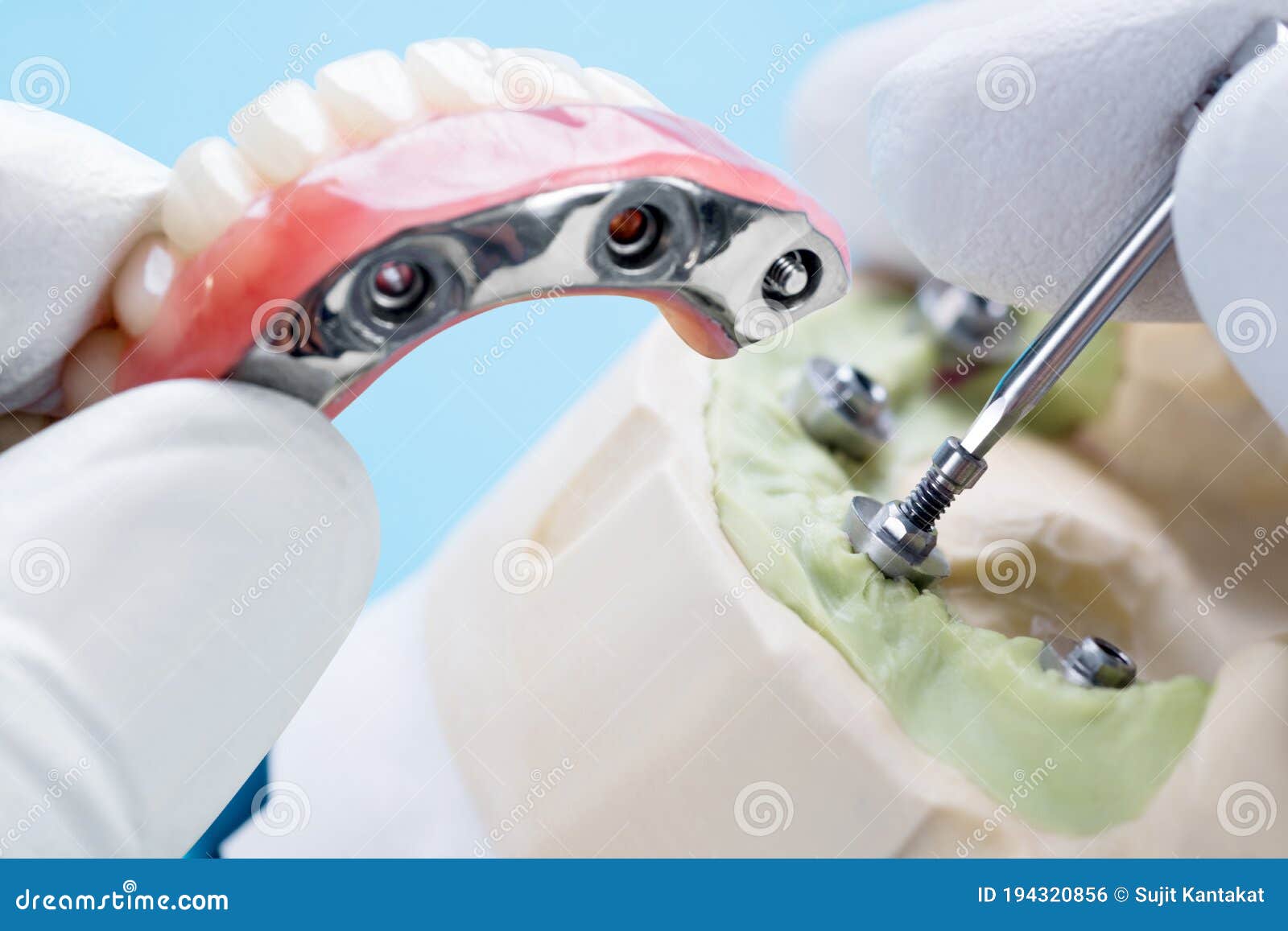 Dental Implant Work is Completed and Ready To Use. Stock Photo Image