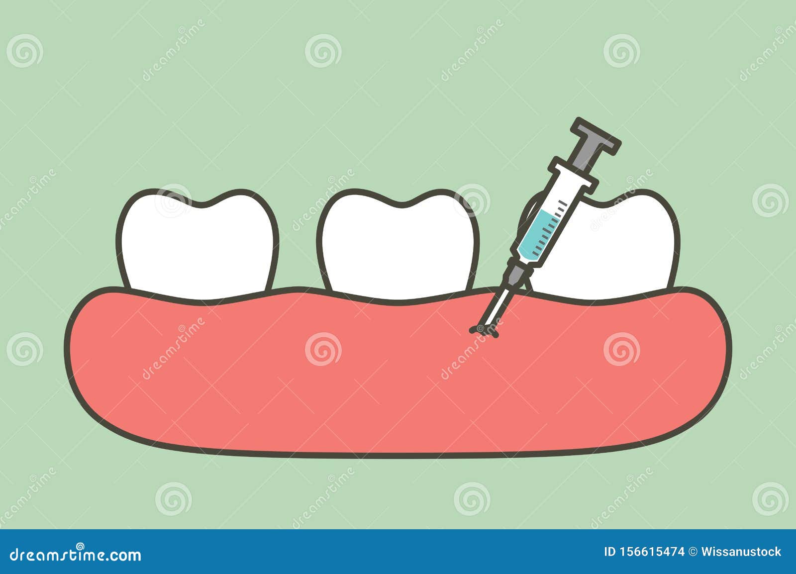 dental injection for tooth extraction, syringe and anesthetizing