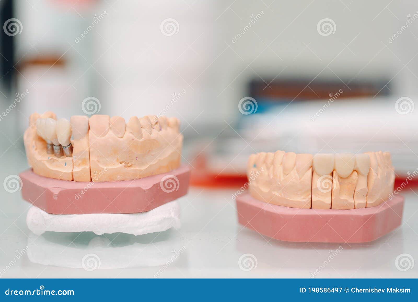Dental Layout of the Human Jaw with Teeth and Implants. Stock Image