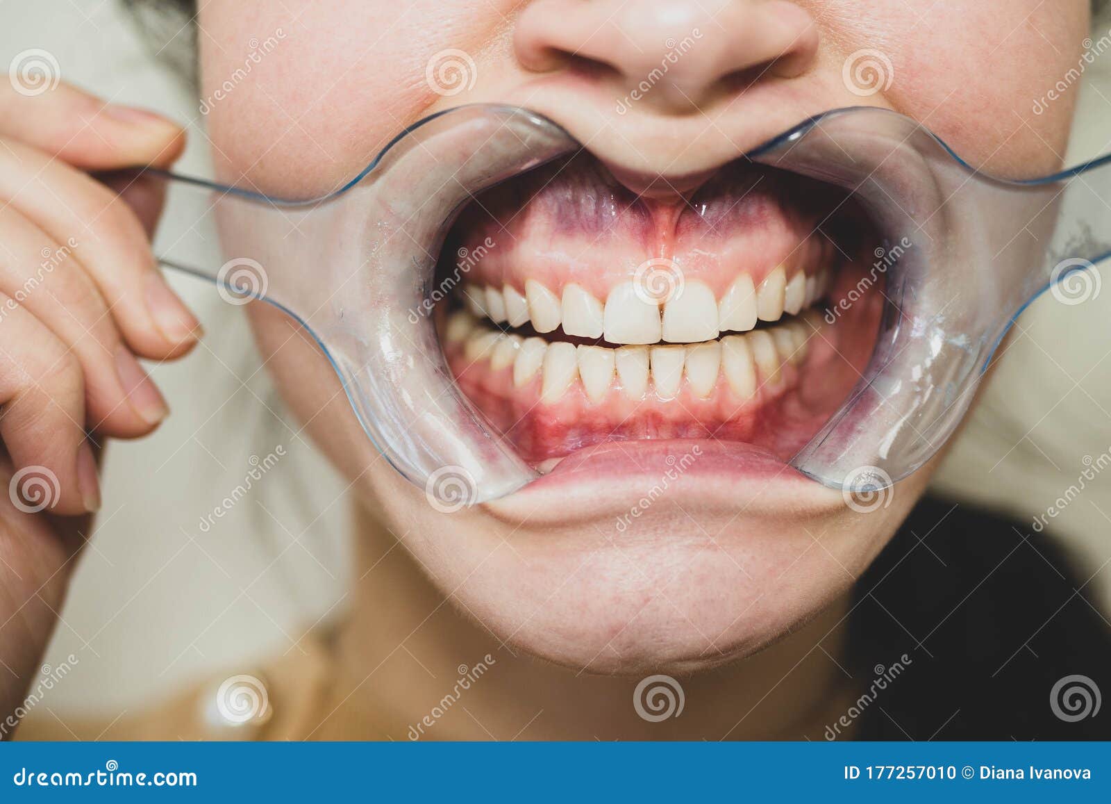 Dental Mouth Spreader Before Teeth Whitening Stock Photo Ima