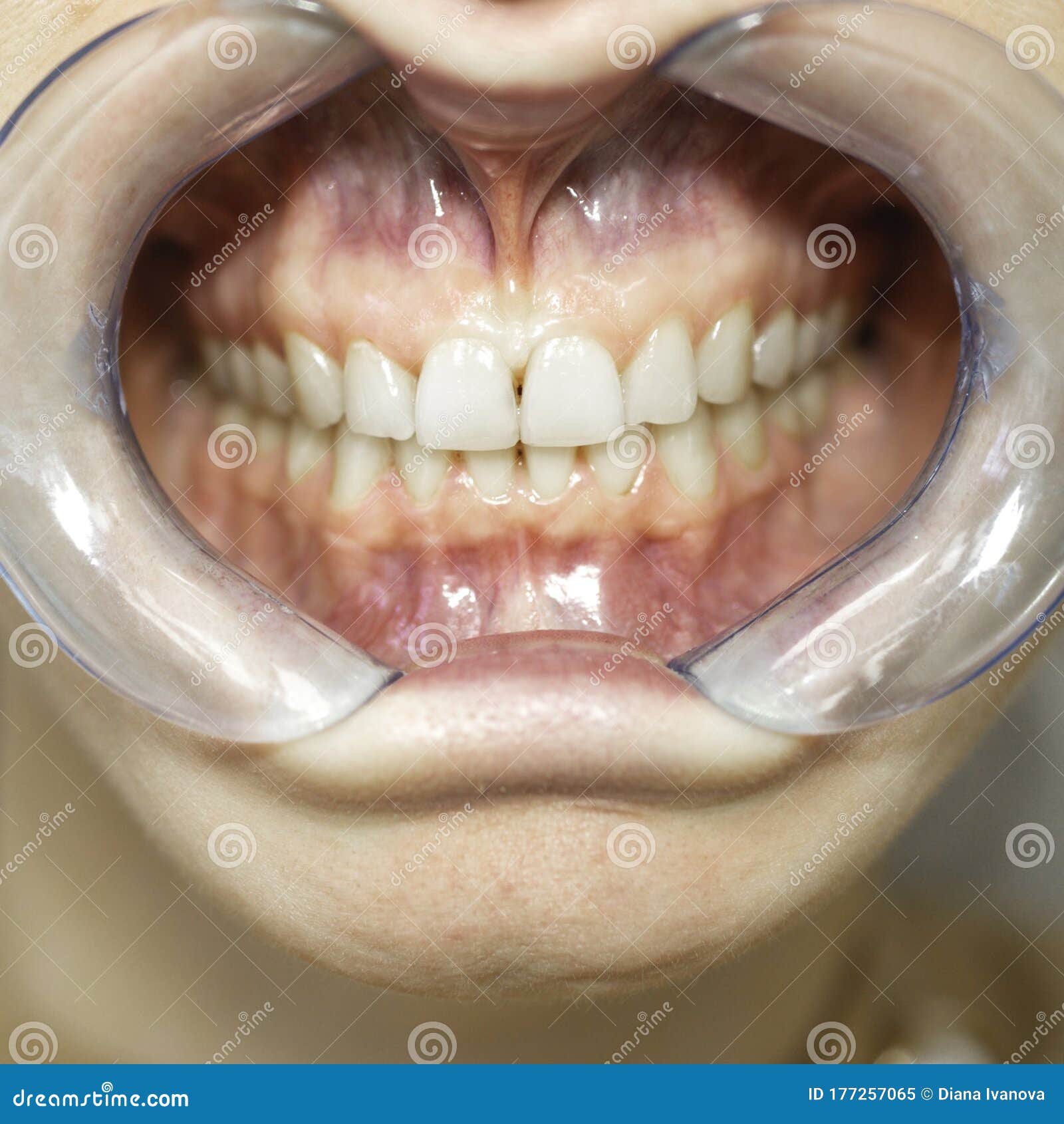 Dental Mouth Spreader Before Teeth Whitening