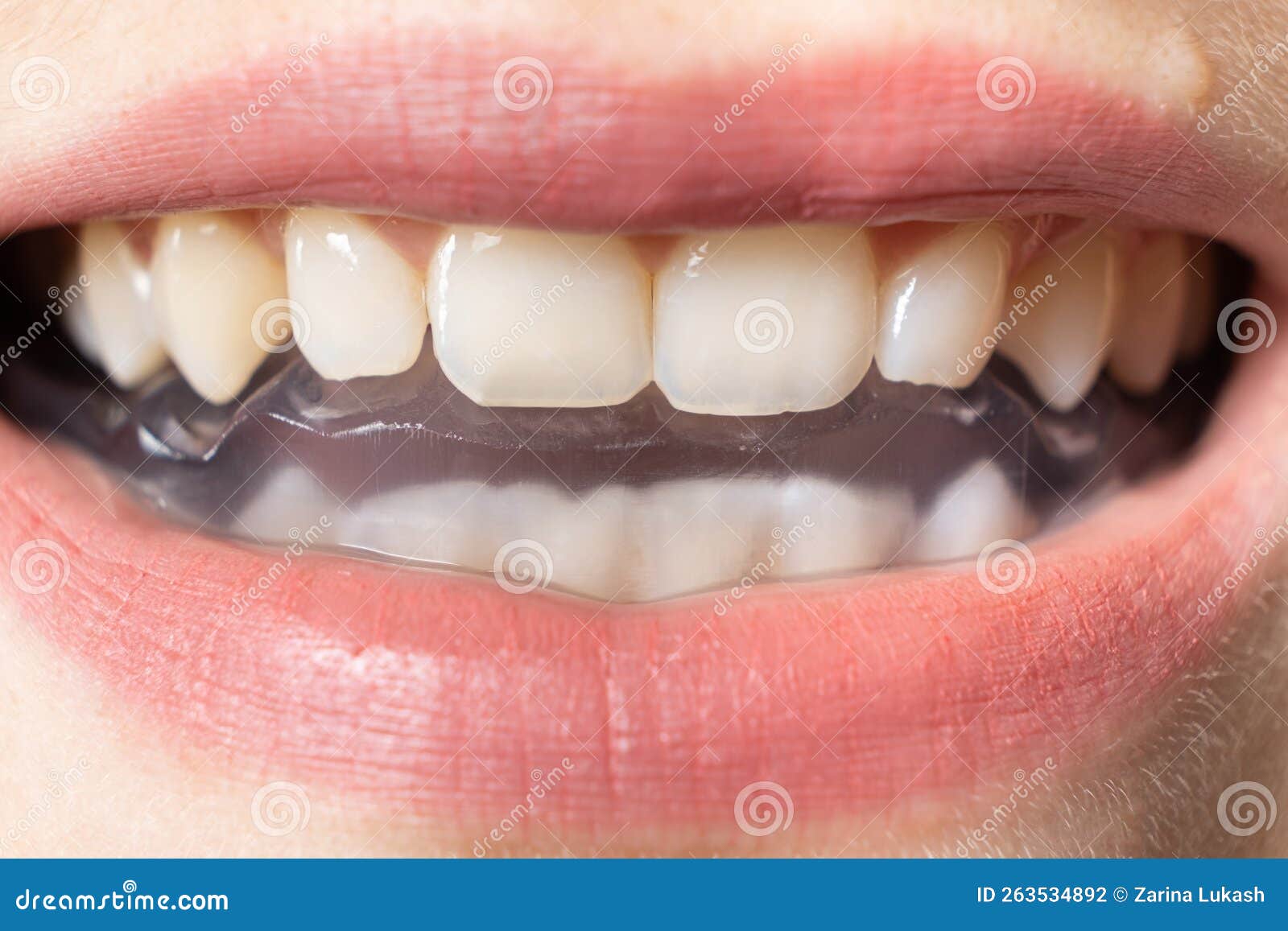 dental mouthguard, splint in the mouth for the treatment of dysfunction of the temporomandibular joints, bruxism