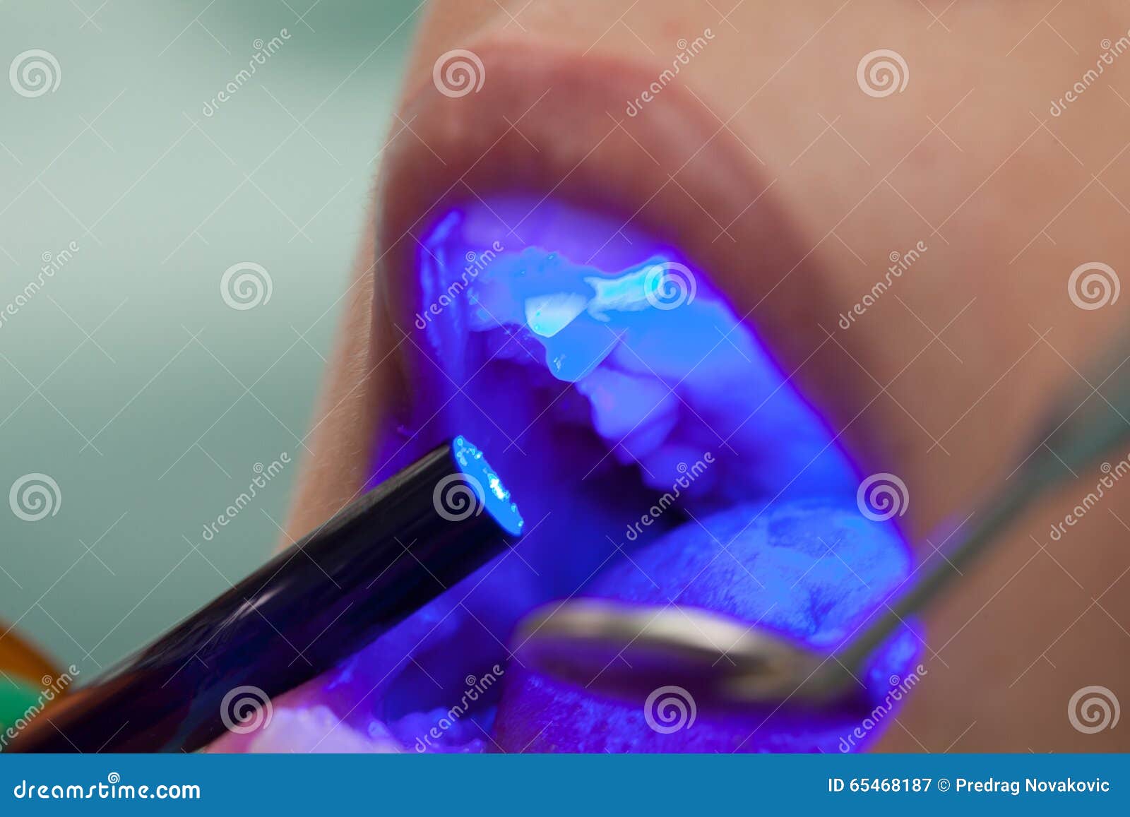 Dental obturation stock image. Image of latex, lamp, dental 65468187
