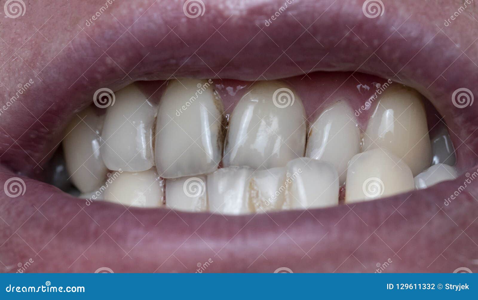 dental plaque on man`s teeth caused by coffee residual
