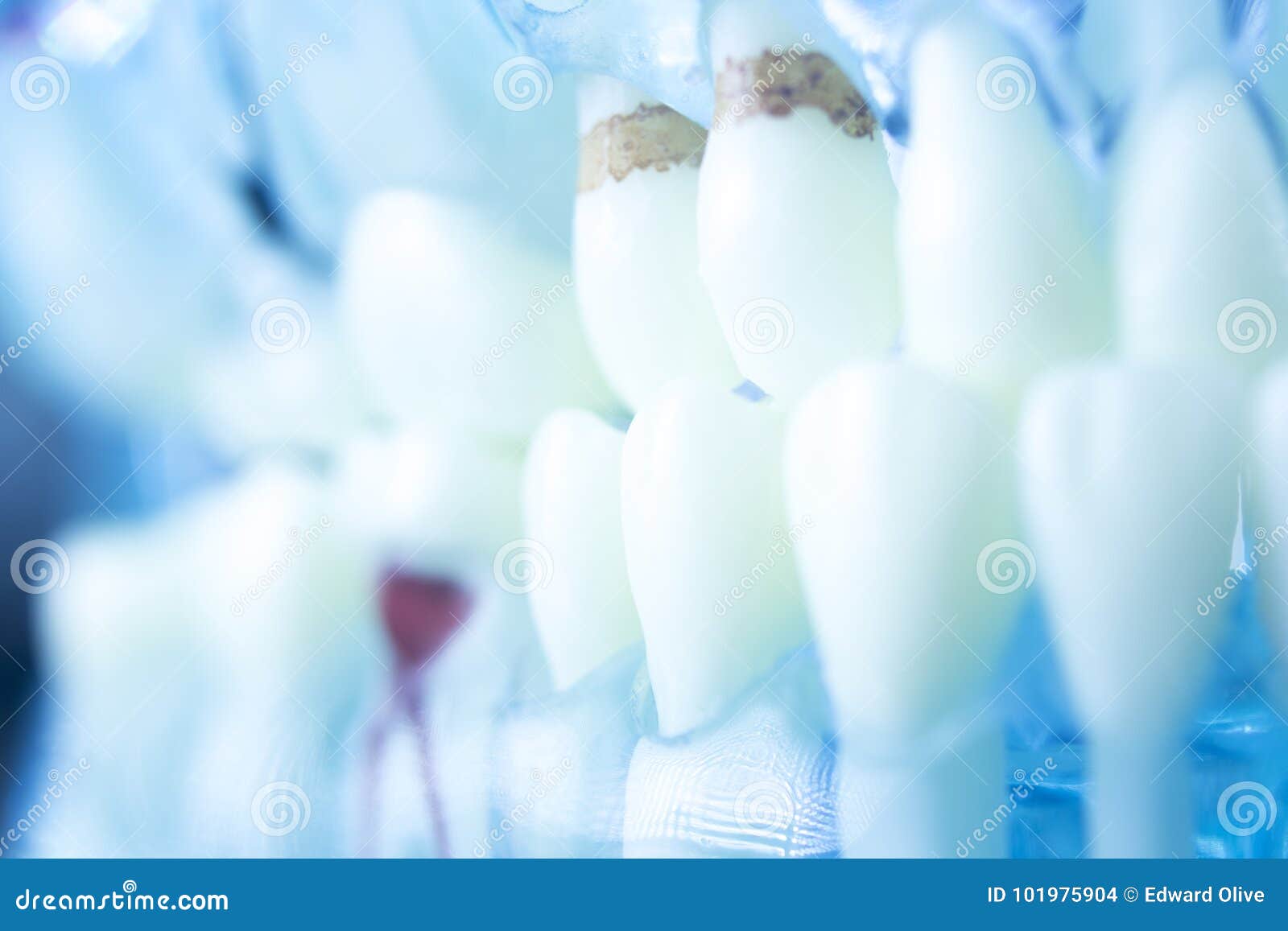 Dental plaque tooth decay stock photo. Image of health 101975904