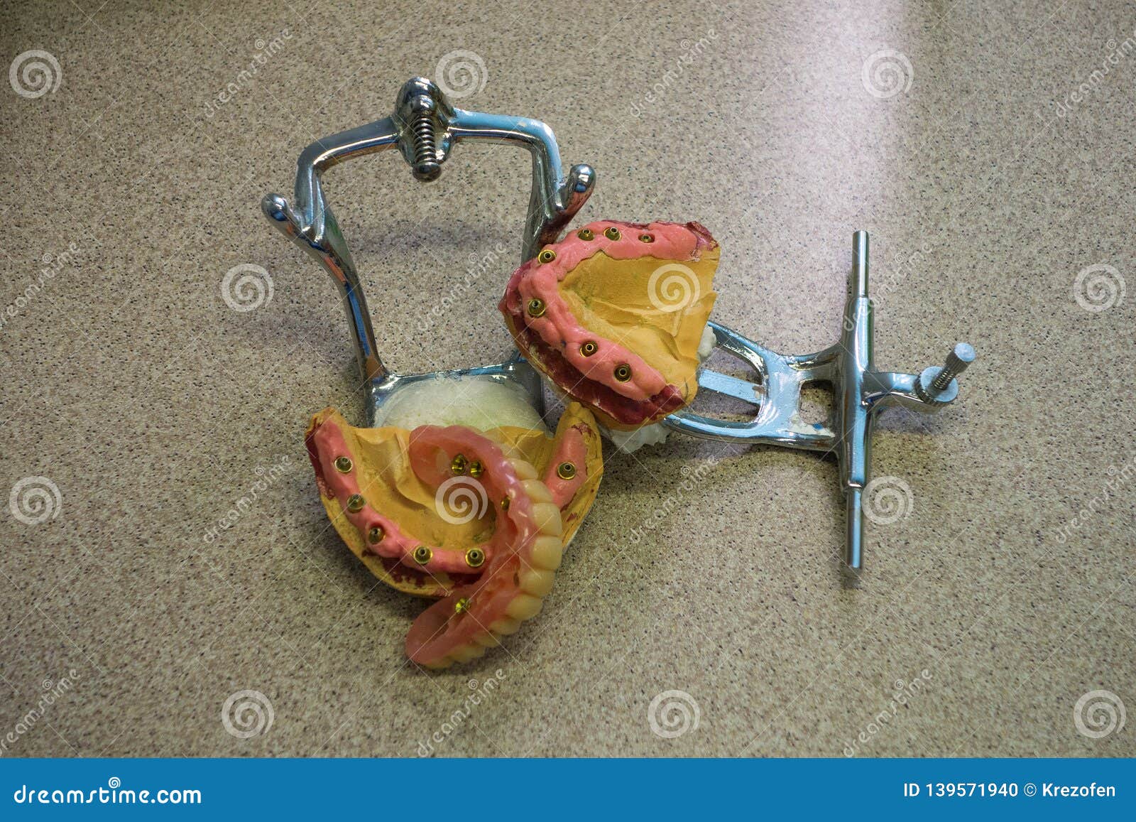 Dental Plaster Model with Exposed Dental Implants Stock Photo Image