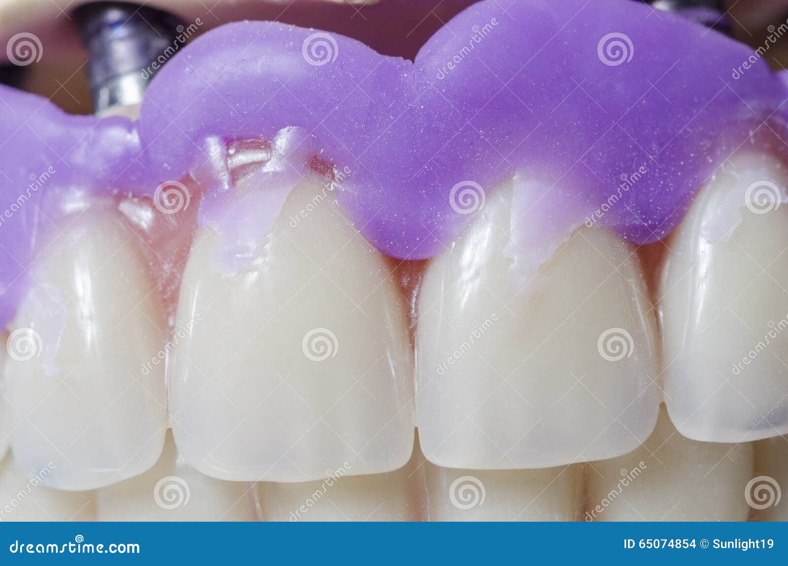 Dental Prosthesis Porcelain Teeth. Stock Photo Image of dentist