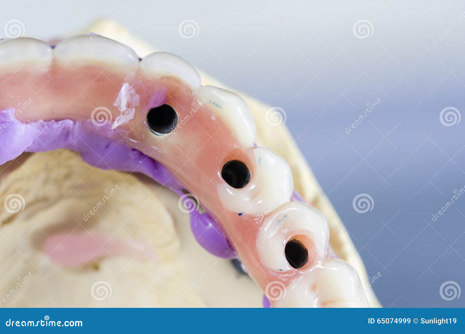 Dental Prosthesis Porcelain Teeth. Stock Image Image of ceramic