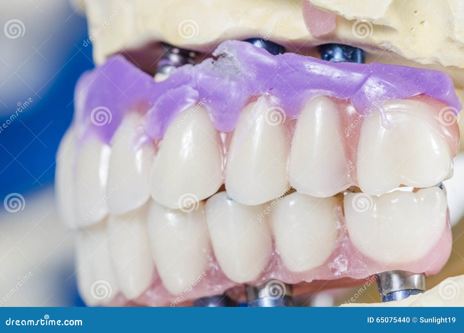 Dental Prosthesis Porcelain Teeth. Stock Photo Image of macro