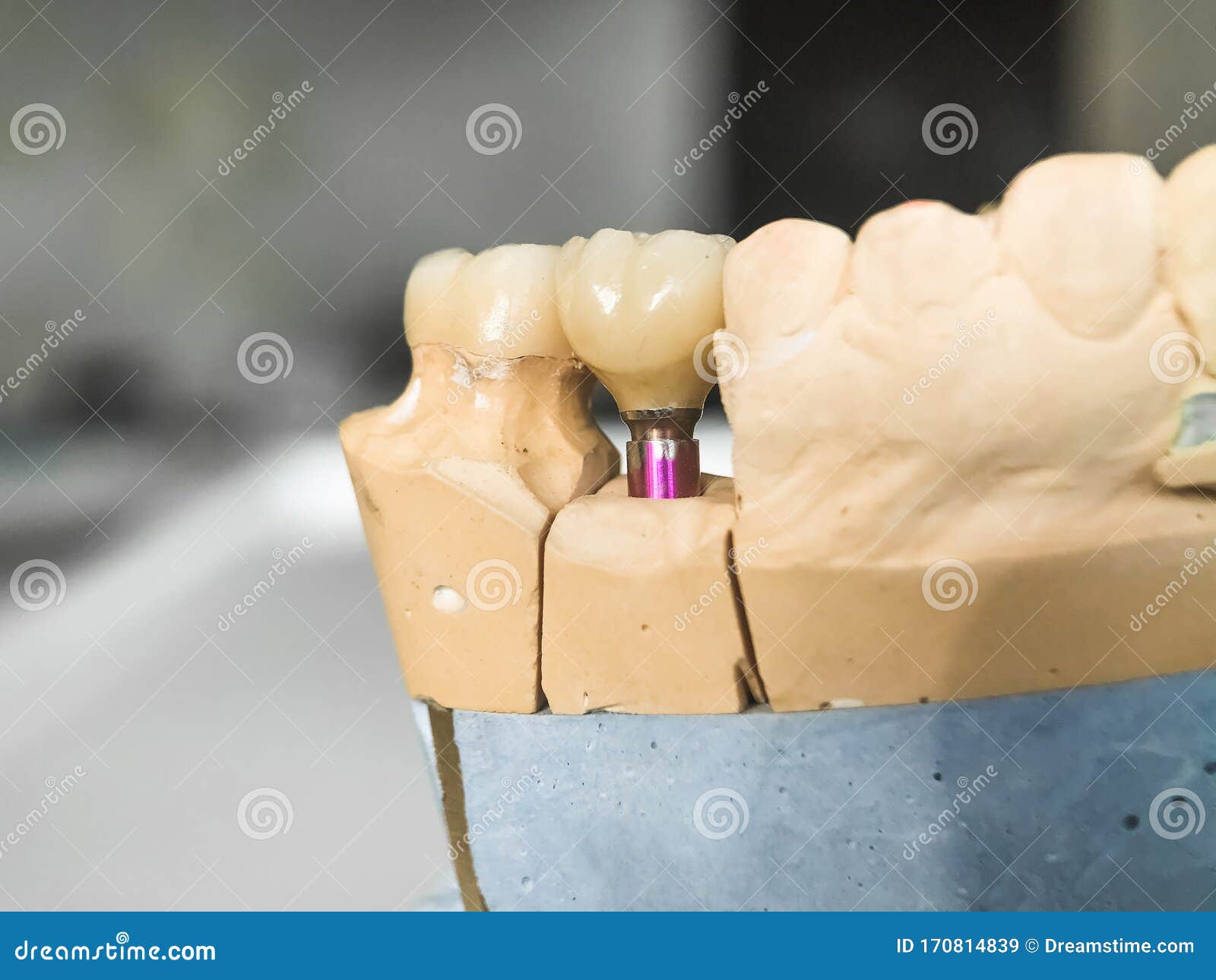 Dental Prosthetics on Implants, Artificial Jaw with Dentures on the