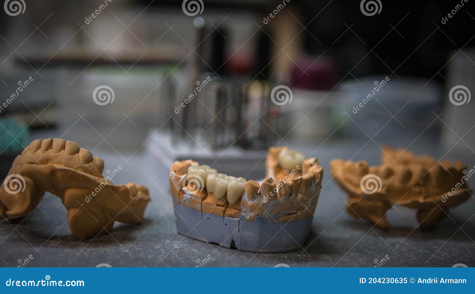 Dental Prosthetics,model with Set Teeth in the Prosthesis. Dental