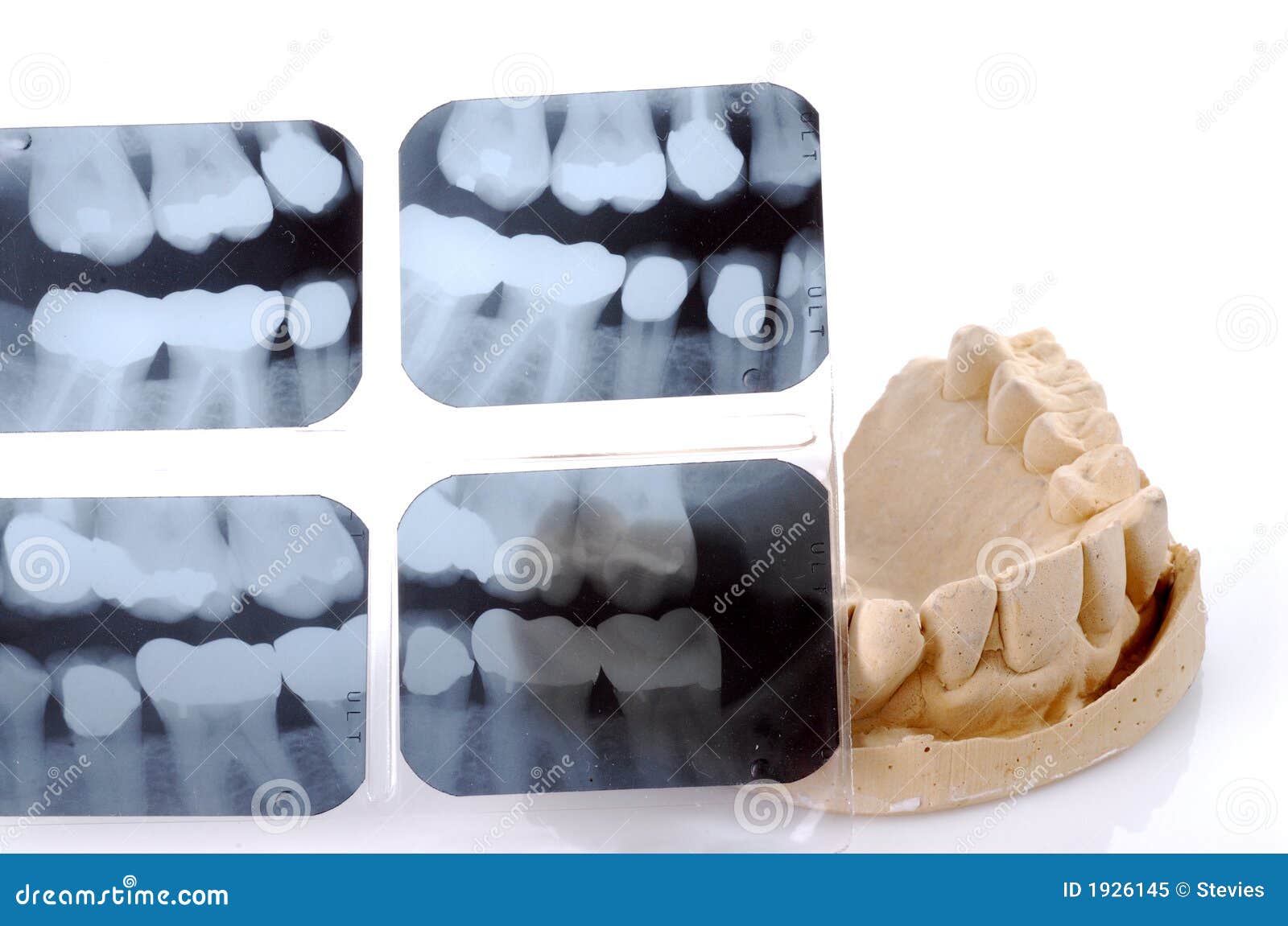 Dental XRay and Casting stock image. Image of xray, denture 1926145
