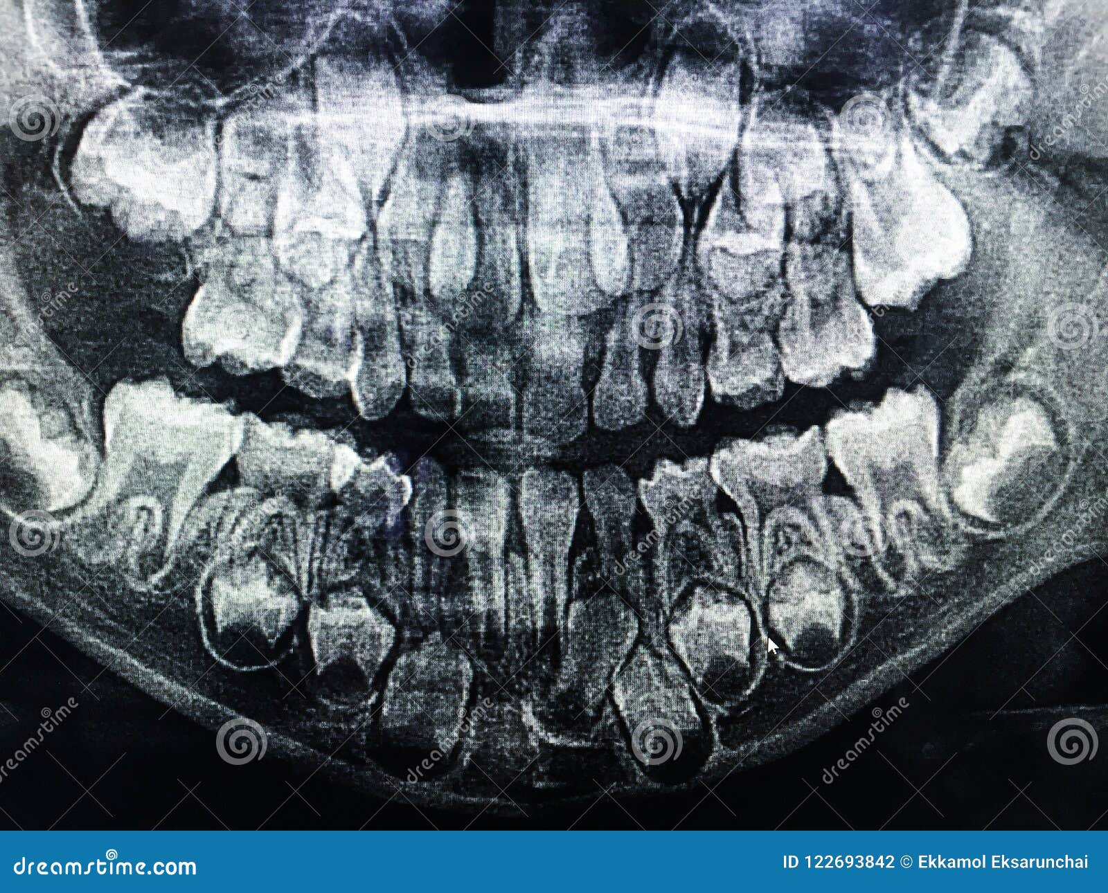 Dental X Ray Of Child 6 Years All Baby Teeth In View Stock Photo