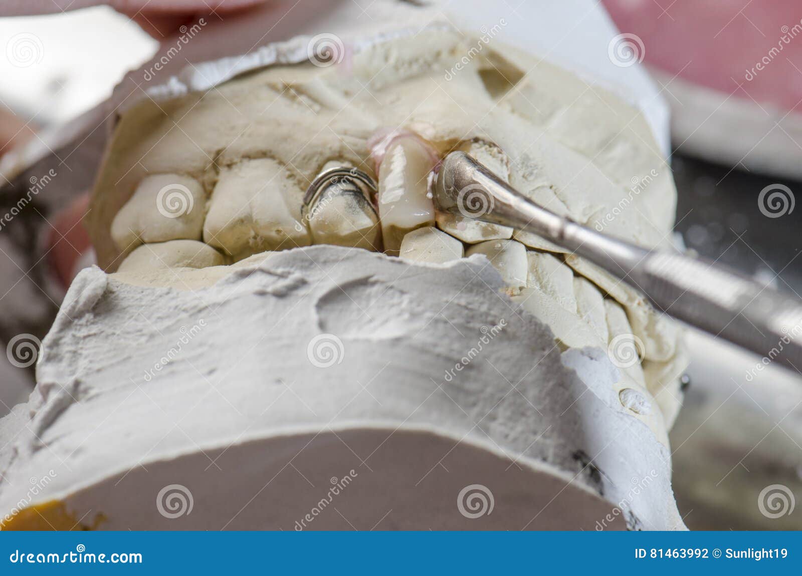 Dental Technician Doing Partial Dentures of Acrylic Resins. Stock Photo