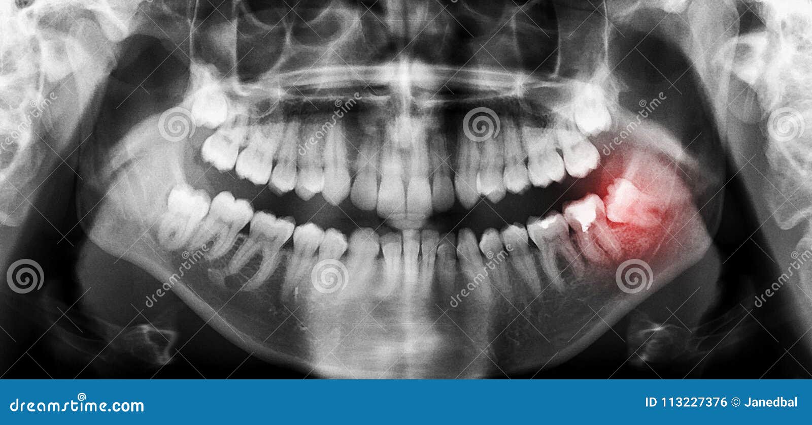 dental teeth x-ray panoramic scan with skewed wisdom tooth