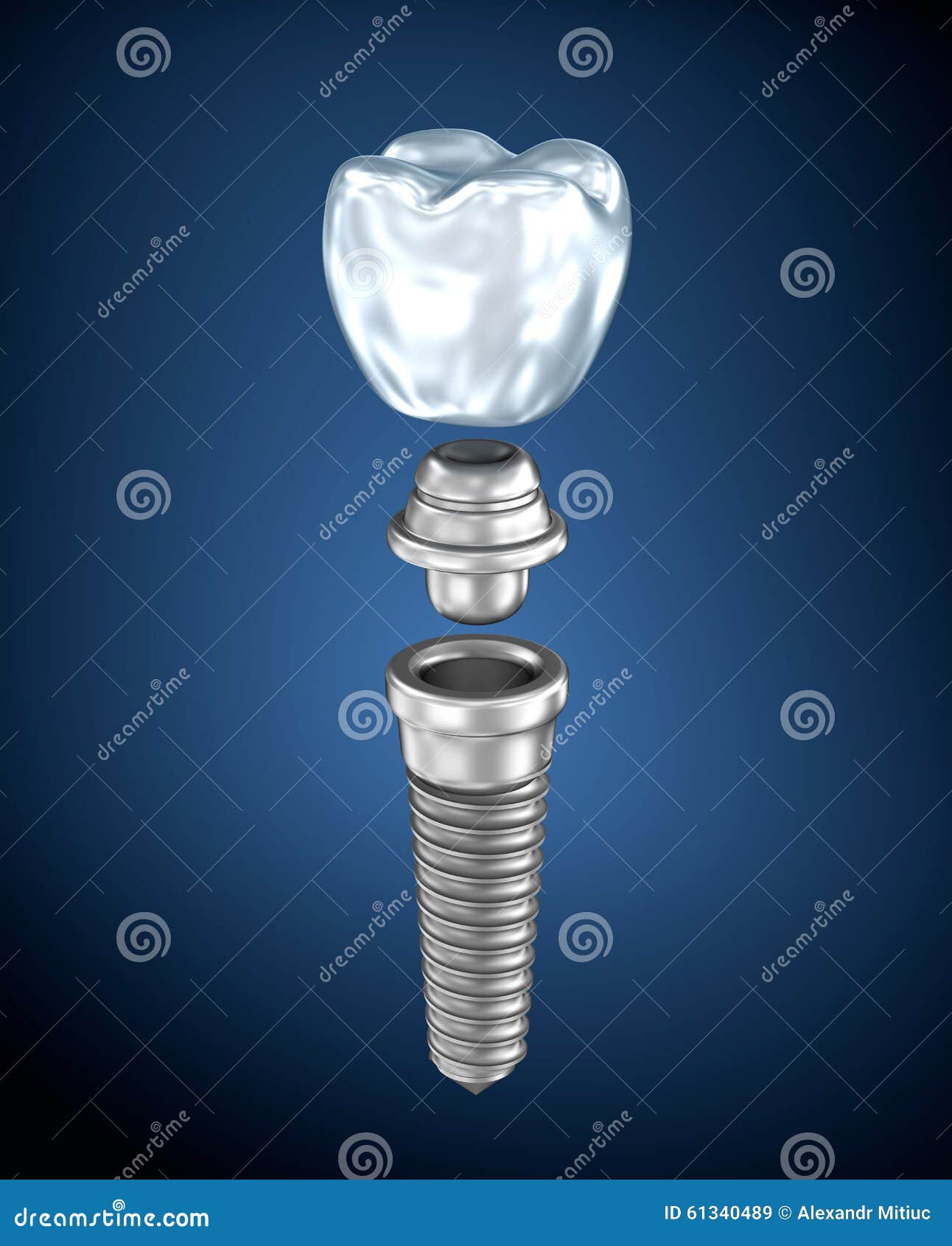 Dental titanium implant stock illustration. Illustration of prosthetic