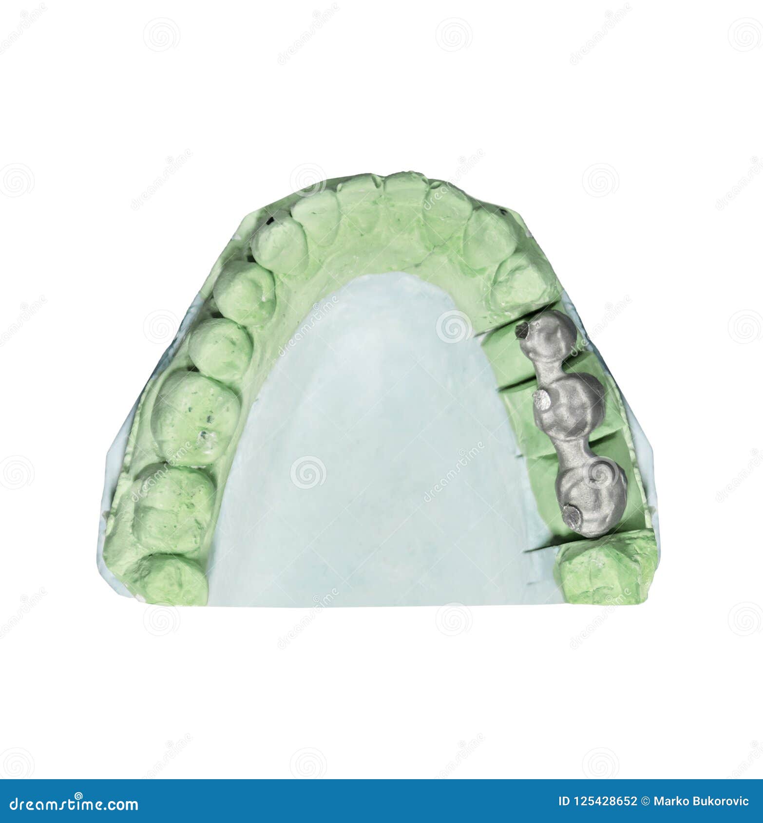 Dental Tooth Implant Plaster Pattern with Metal Bridge Isolated Stock