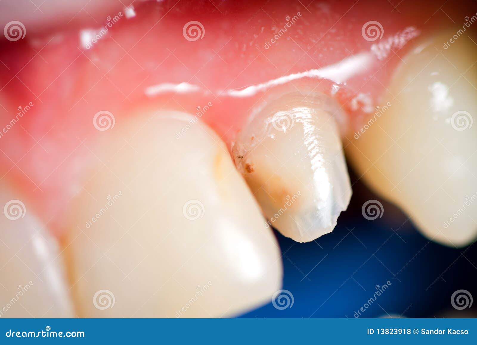 secondary caries