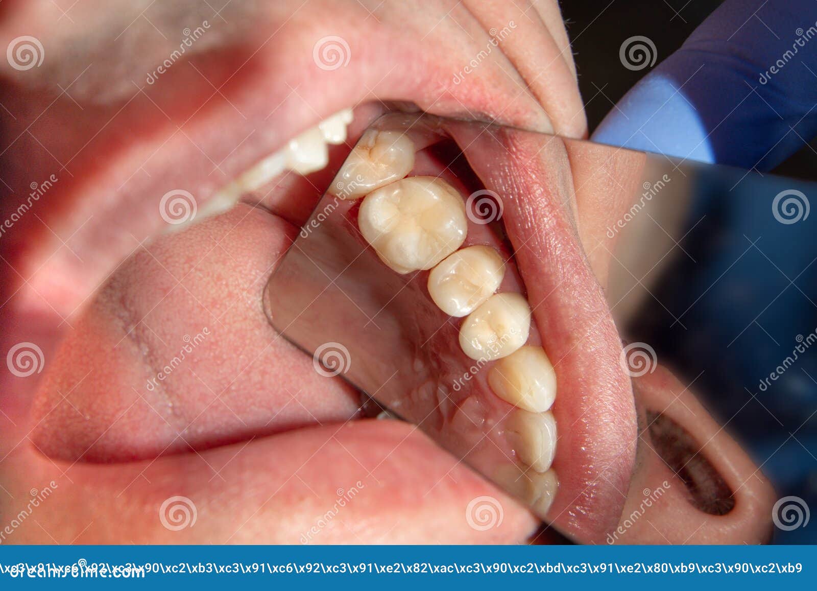 dental treatment in dental clinic. rotten carious tooth macro. treatment endodontic canals