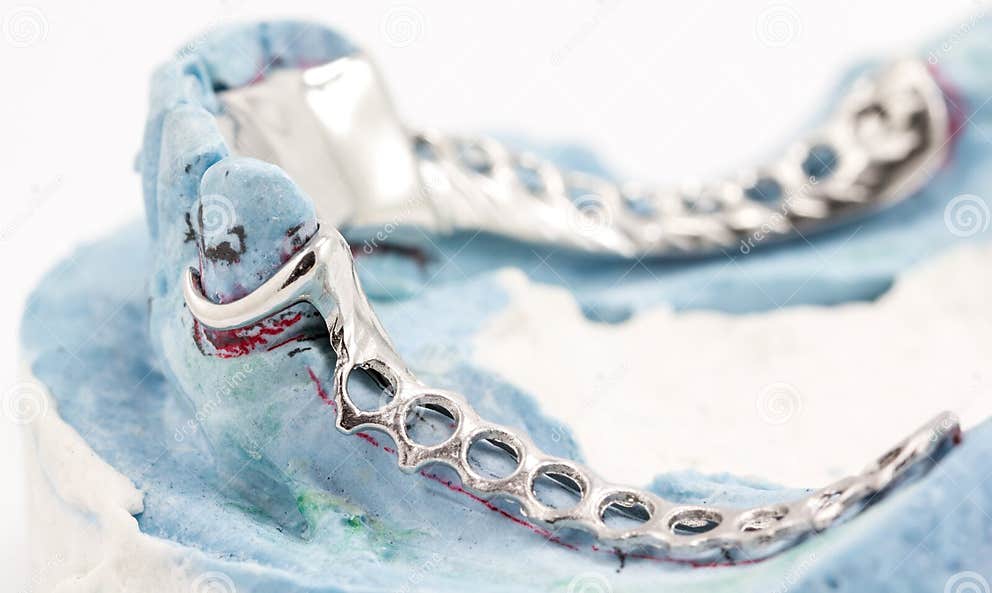 Dental wire bending stock photo. Image of close, bridge 40090374