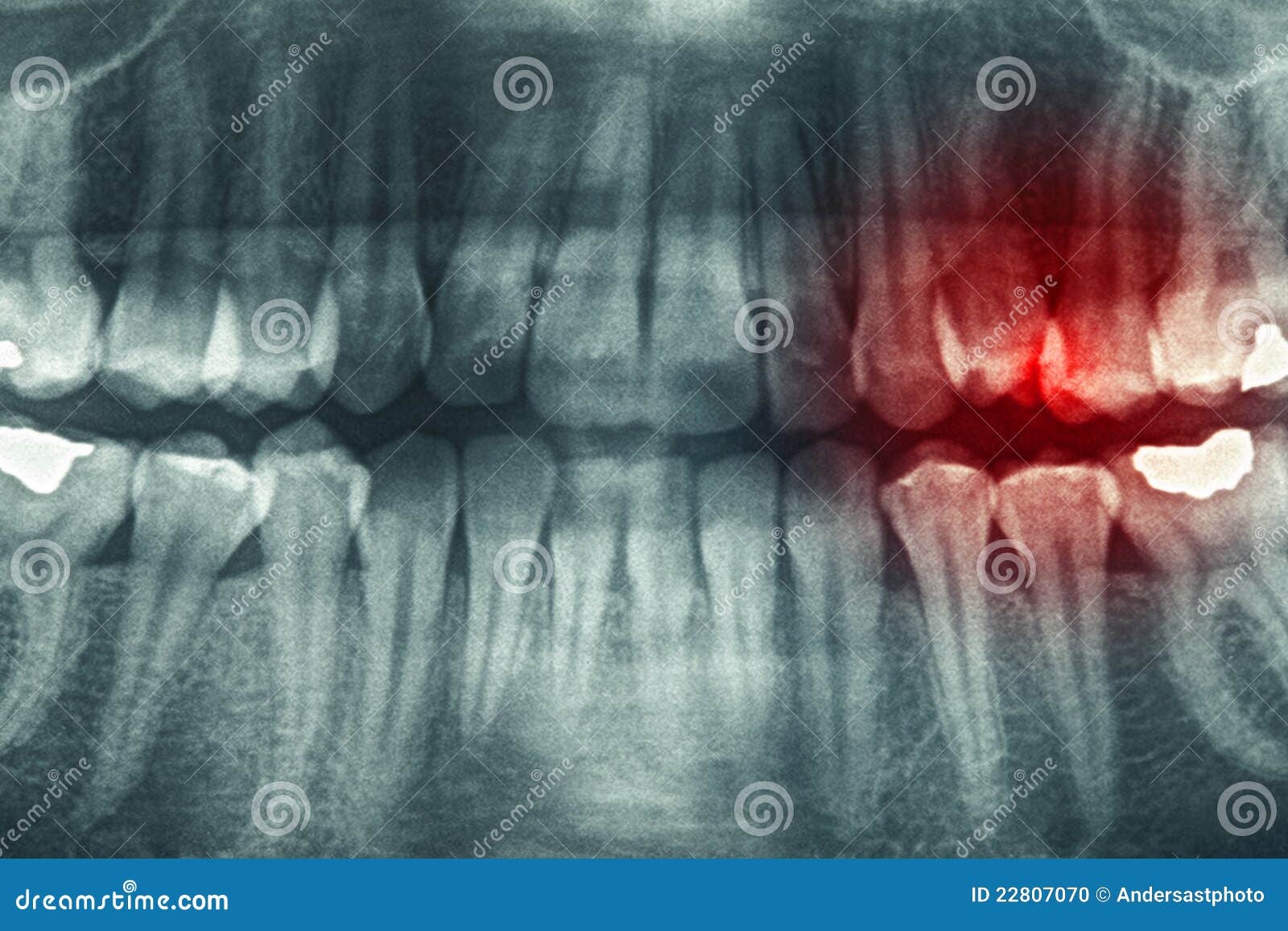 Dental xray stock photo. Image of dentistry, radiation 22807070