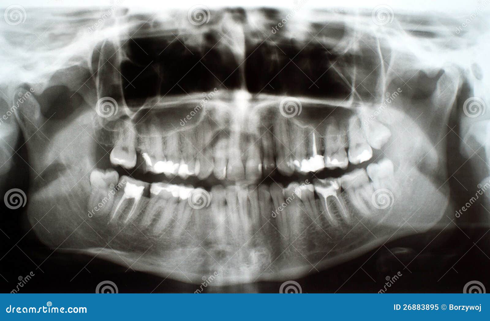 Dental xray stock image. Image of dentine, mouth, cement 26883895