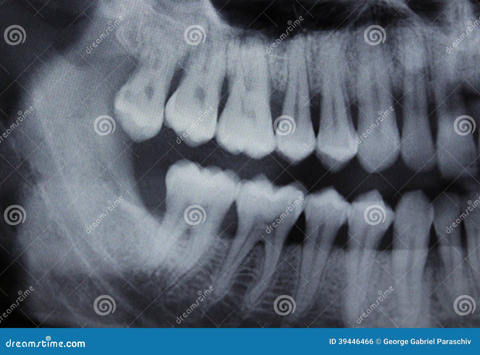 Dental Xray left half stock photo. Image of examine, dental - 39446466