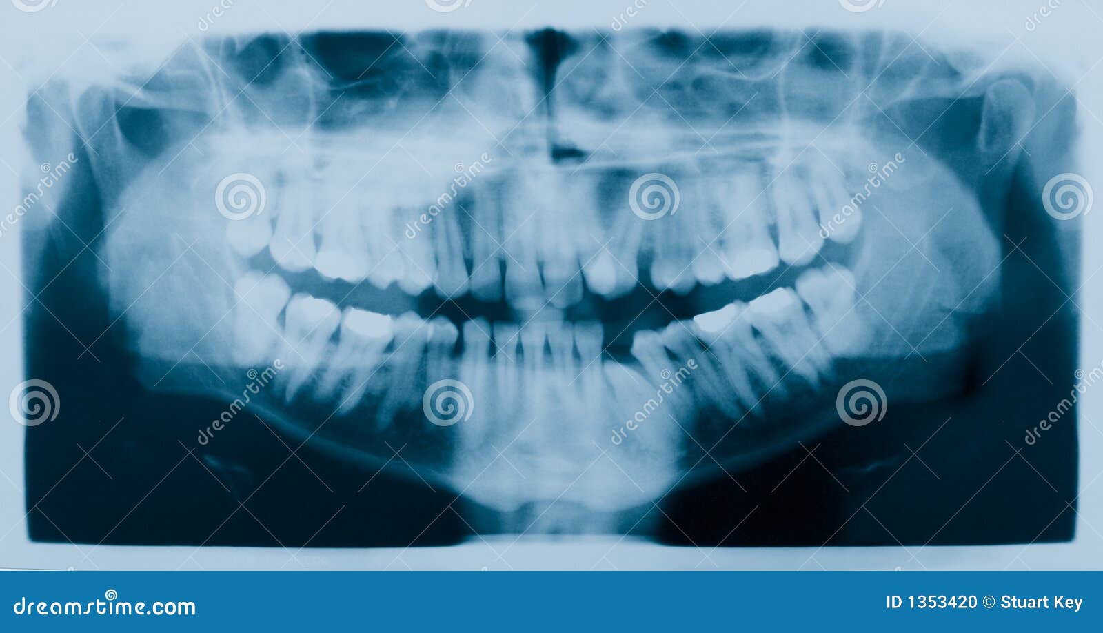 Dental Xray (xray) stock photo. Image of head, cavities 1353420