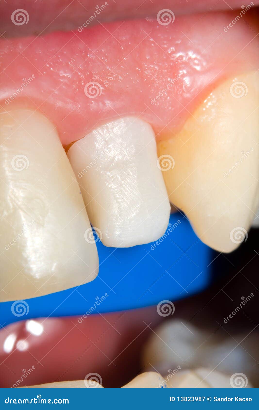 Dental zircon for ceramics stock image. Image of ceramic 13823987