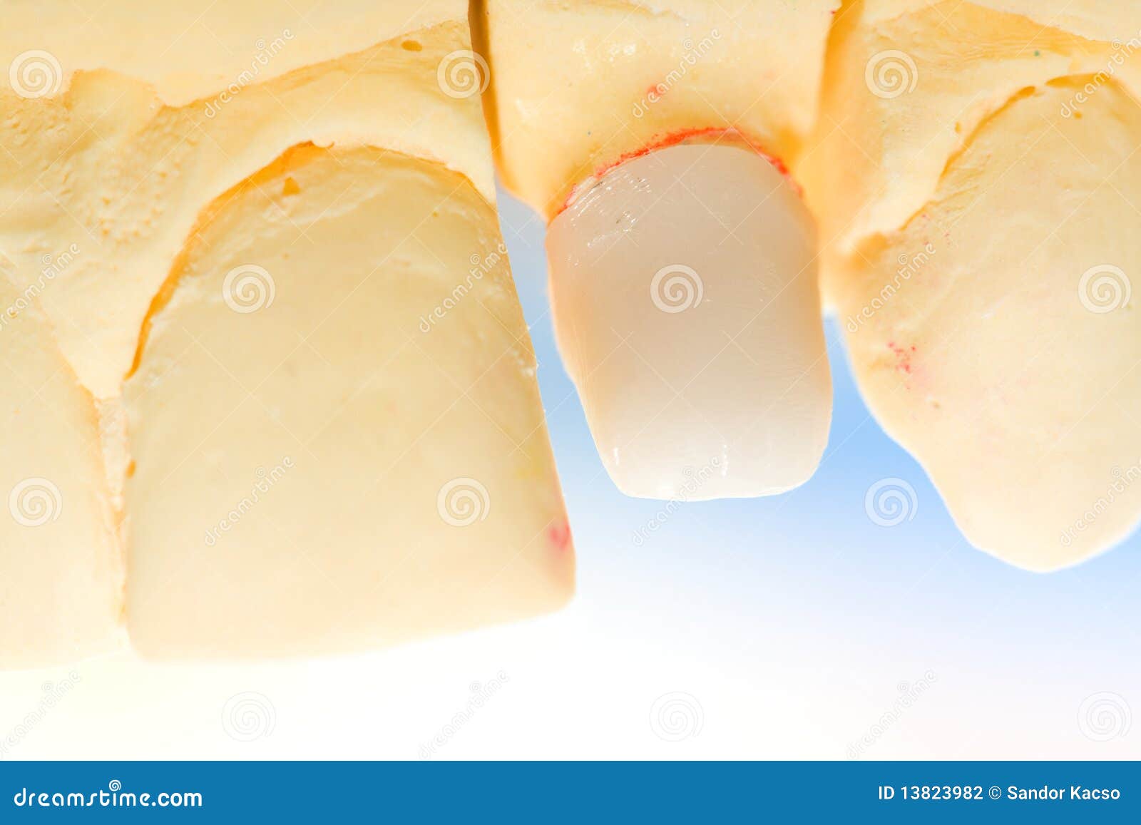 Dental Zirconia for Ceramics Stock Photo Image of dentistry, clinical