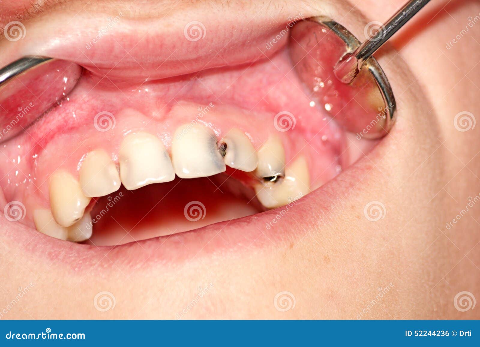 Featured image of post Imagens De Dente Cariado / Baixe dentes podres fotos no melhor site de banco de imagens, com milhões de fotos, imagens e figuras sem royalties e de alta qualidade premiu com preços acessíveis.