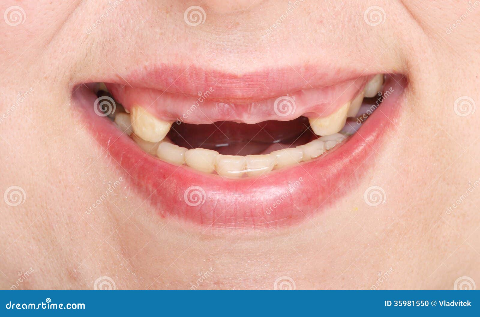Featured image of post Imagens De Dente Podre : O dente podre é um problema infelizmente muito recorrentes nos consultórios de odontologistas de todo o mundo, e que pode ter inúmeras causas.
