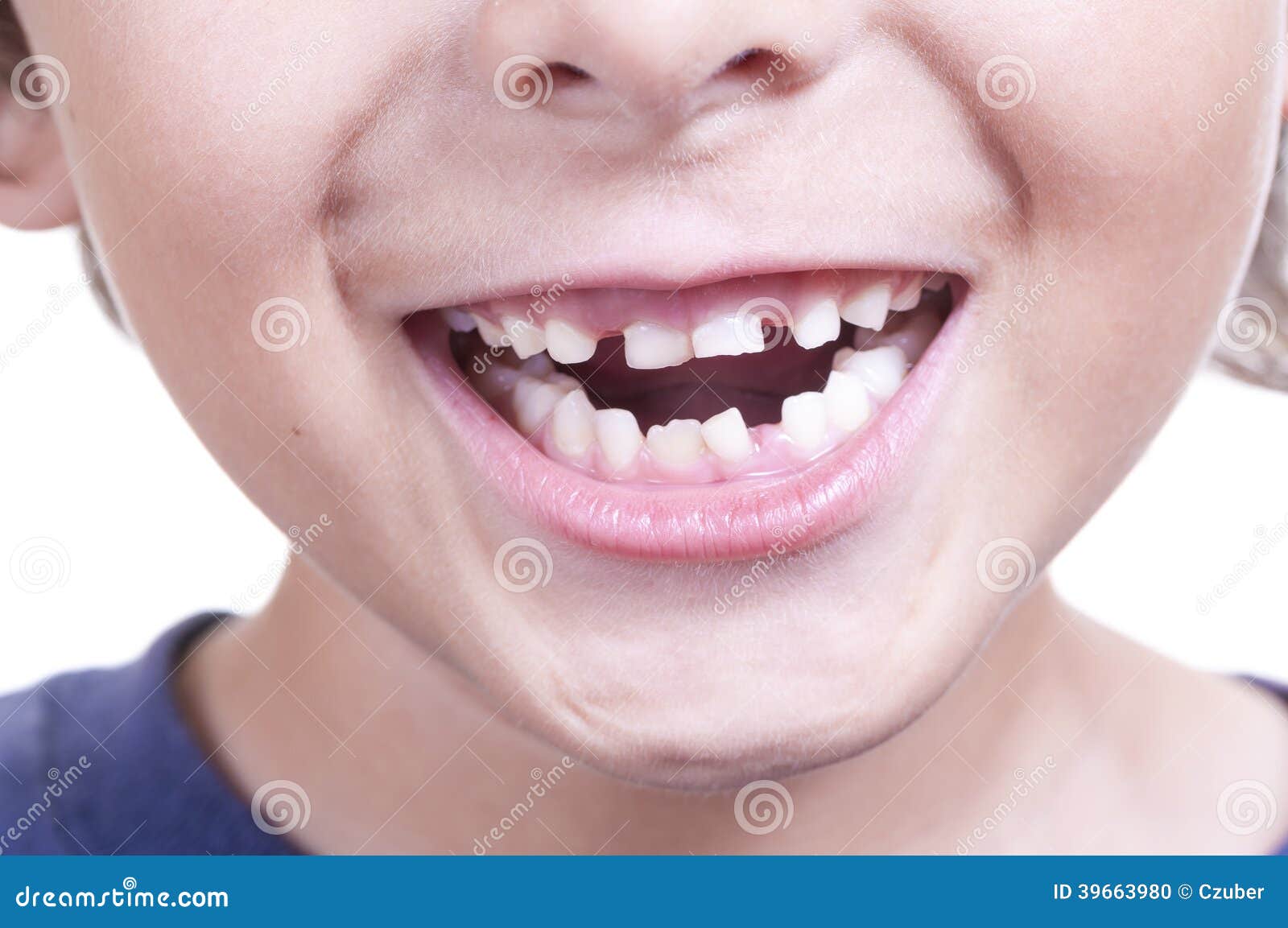 Dente Che Cresce Sopra Dente Da Latte Denti da latte fotografia stock. Immagine di aperto, allentato - 39663980