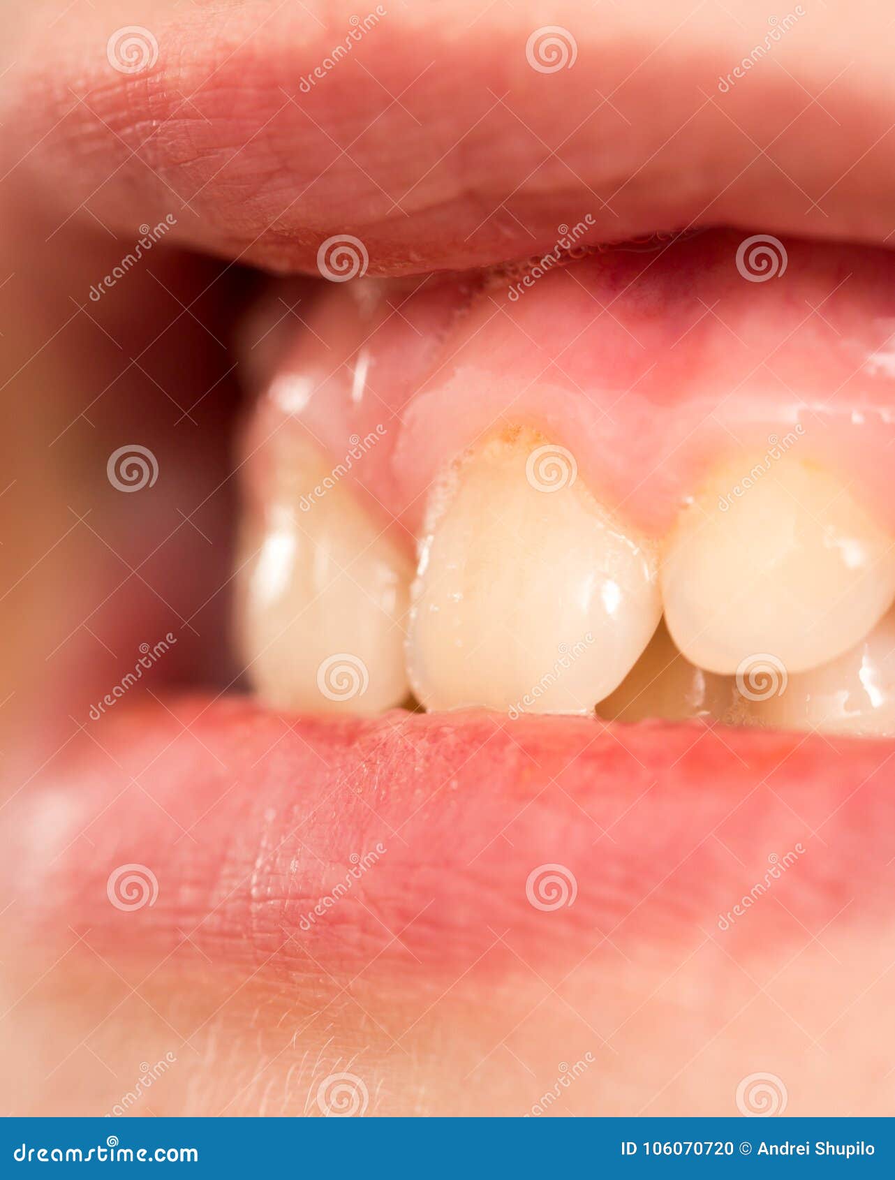 Dente Che Cresce Sopra Dente Da Latte Denti da latte Macro fotografia stock. Immagine di sano - 106070720