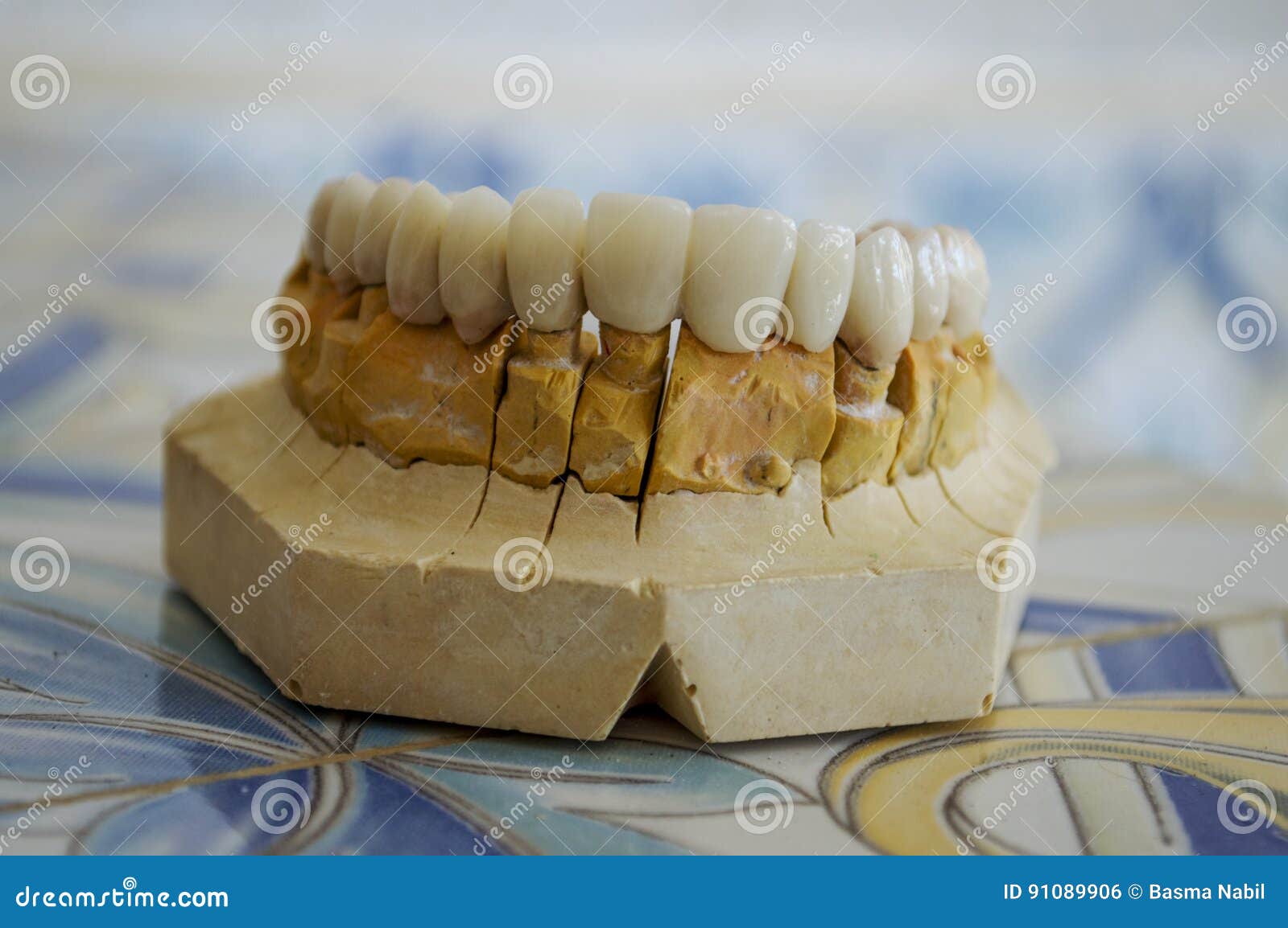 Denti In Porcellana - Ponte Dentale Immagine Stock - Immagine Di - Foto 4