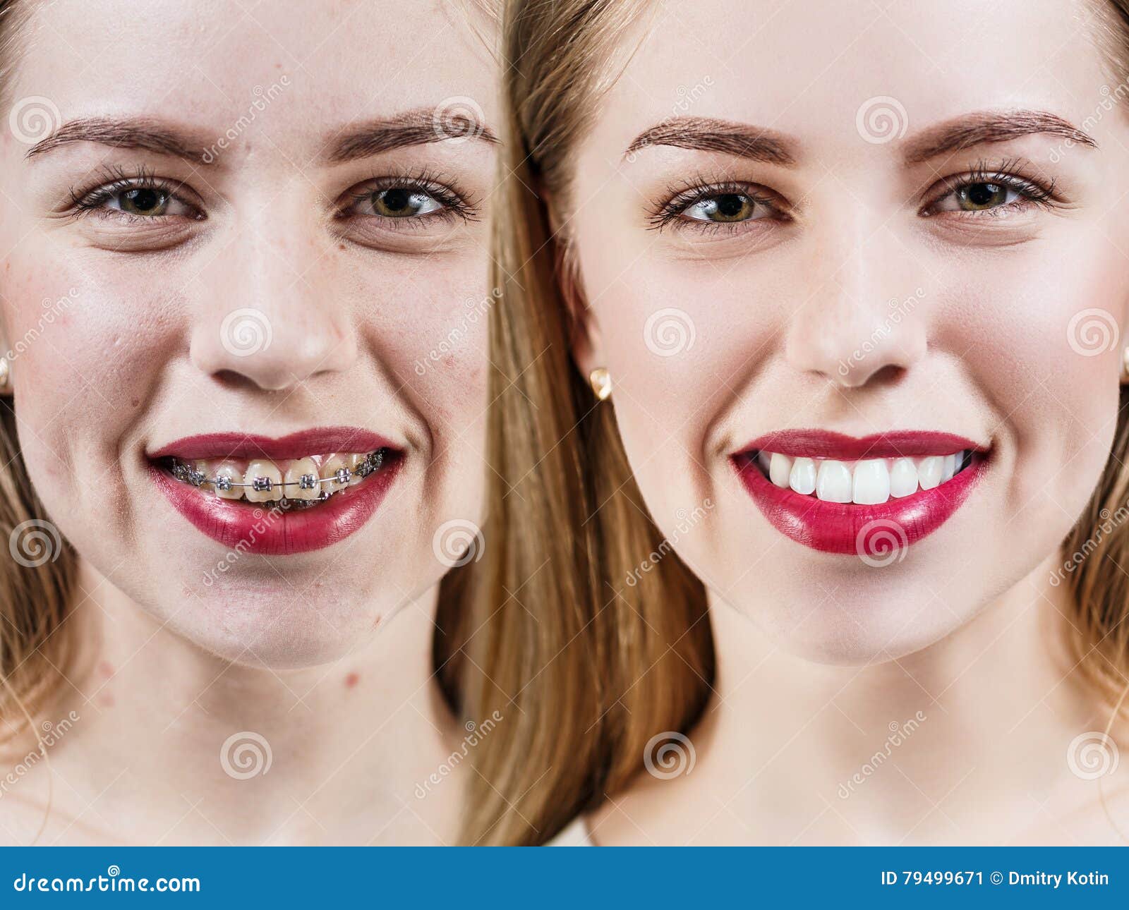 Denti Perfetti Prima E Dopo I Ganci Immagine Stock Immagine Di Correzione Staffe
