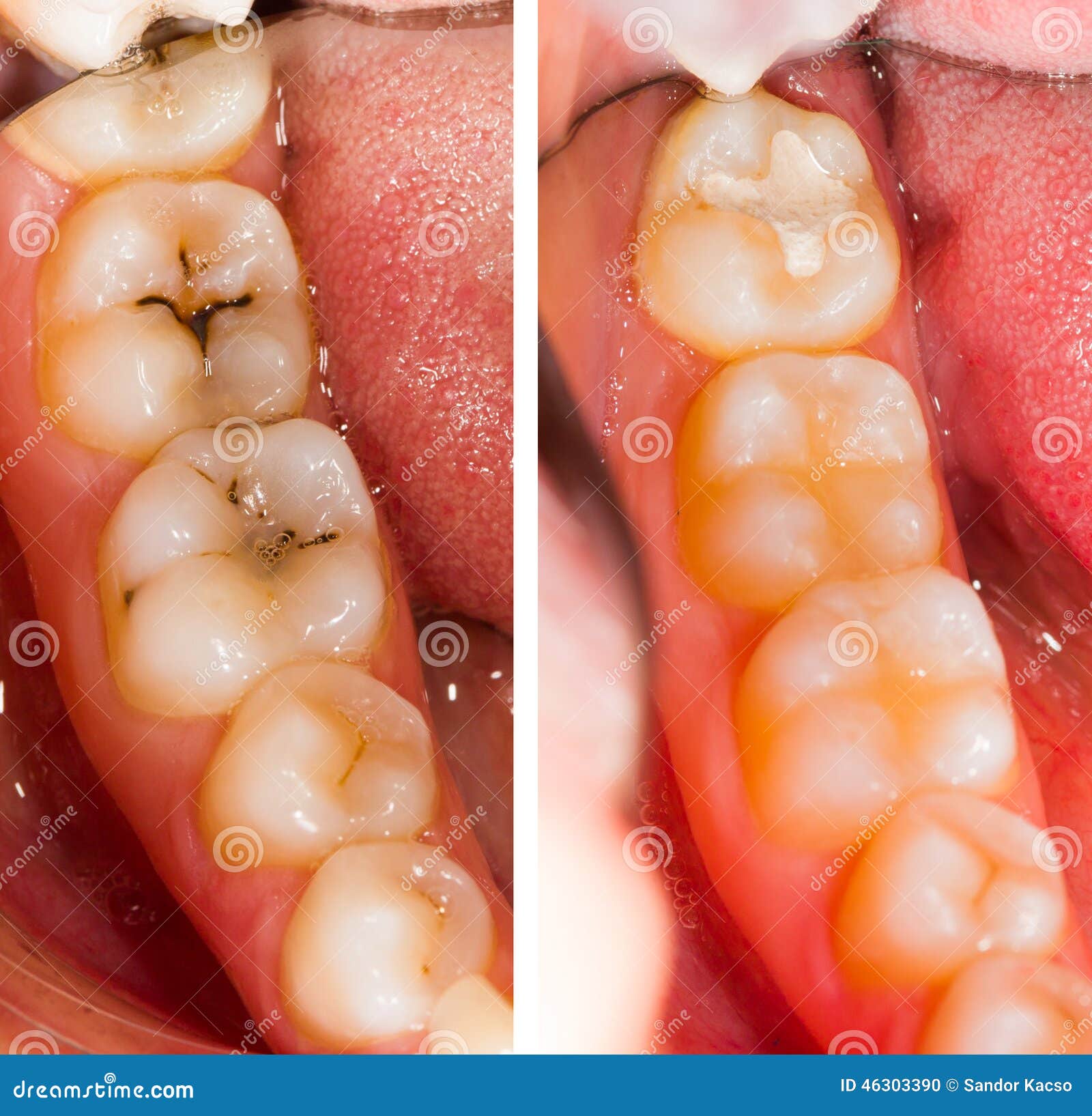 Dental Treatment Beforeafter Series Stock Photos - Free \u0026 Royalty-Free  Stock Photos from Dreamstime, image size:1600x1635