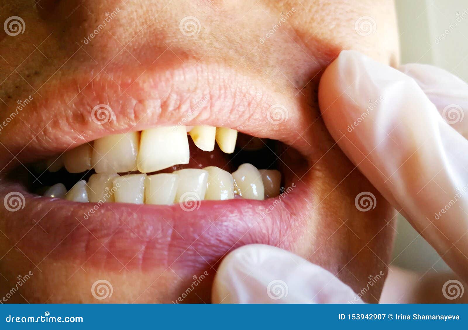 sharpened human teeth