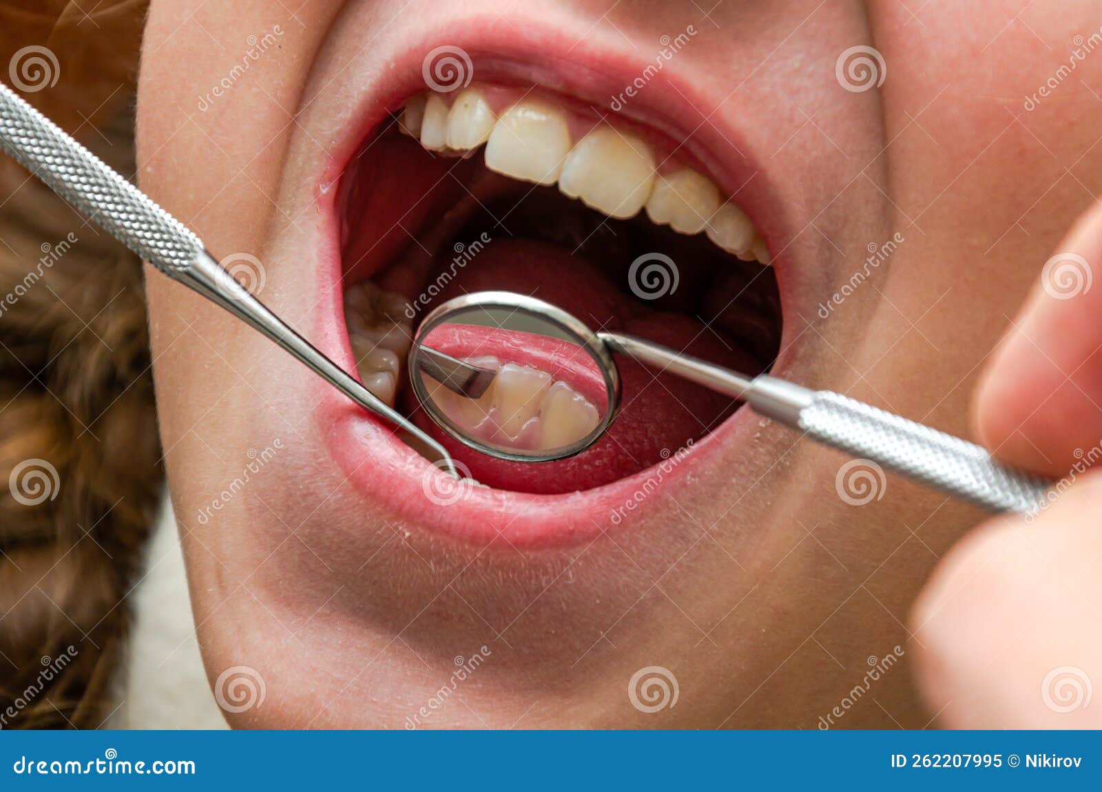 Dentist Examining Patient`s Teeth with a Dental Mirror Stock Image