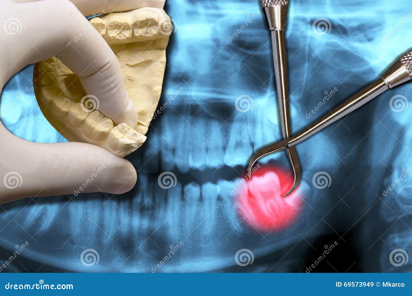 dentist hand show molar tooth