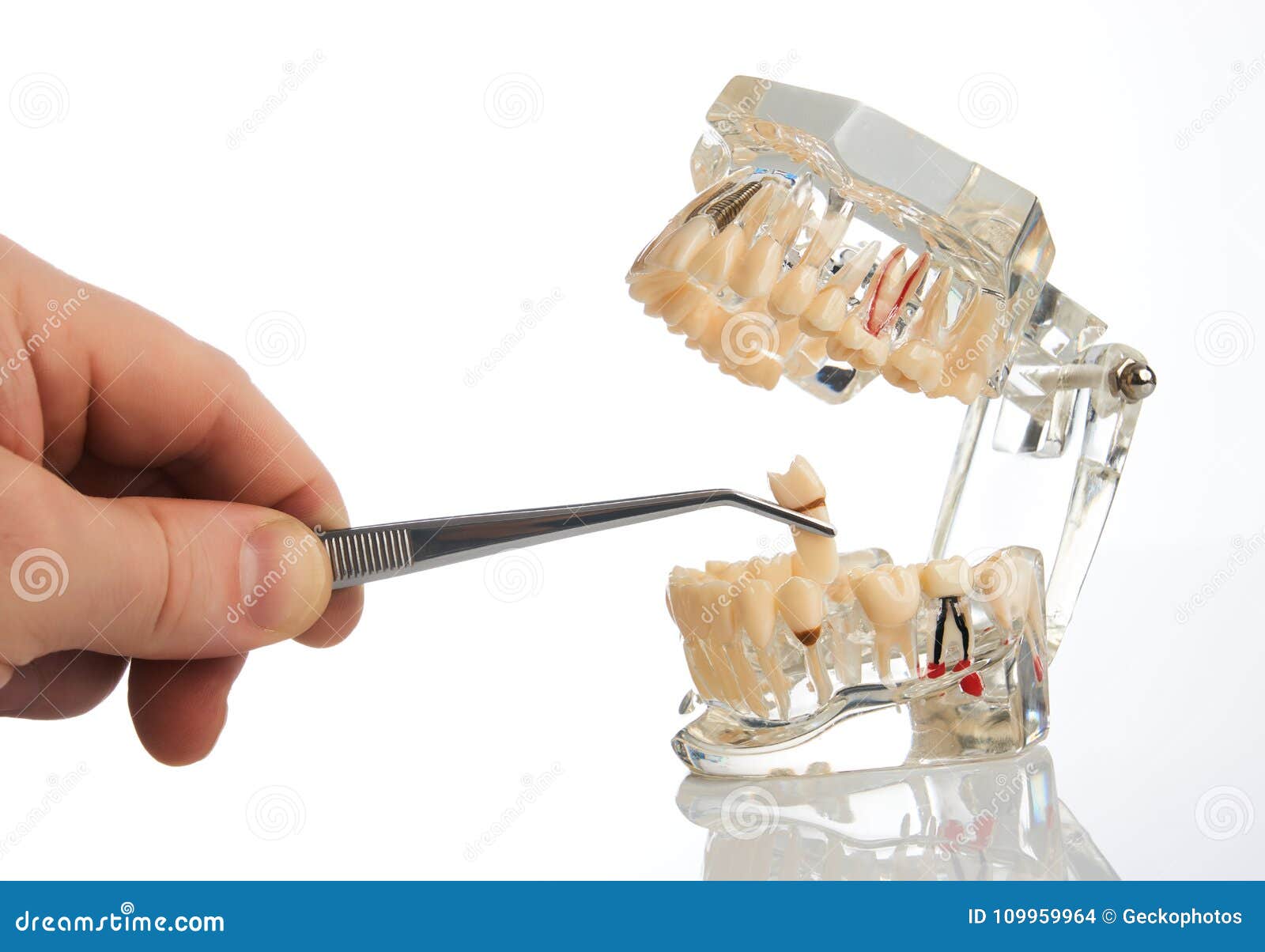 Dentist Hands Pulls Out a Tooth with Dental Forceps Stock Photo Image