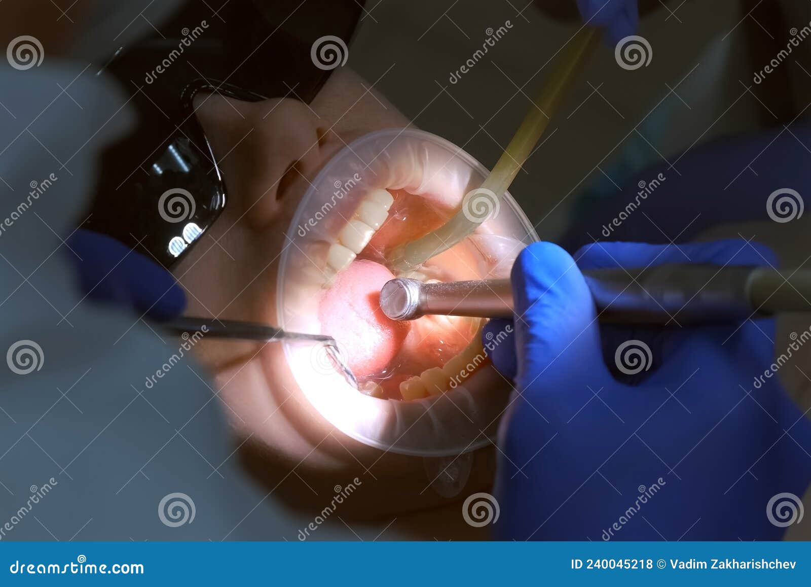 Dentist is Preparing Woman S Teeth for Installing Ceramic Veneers Using