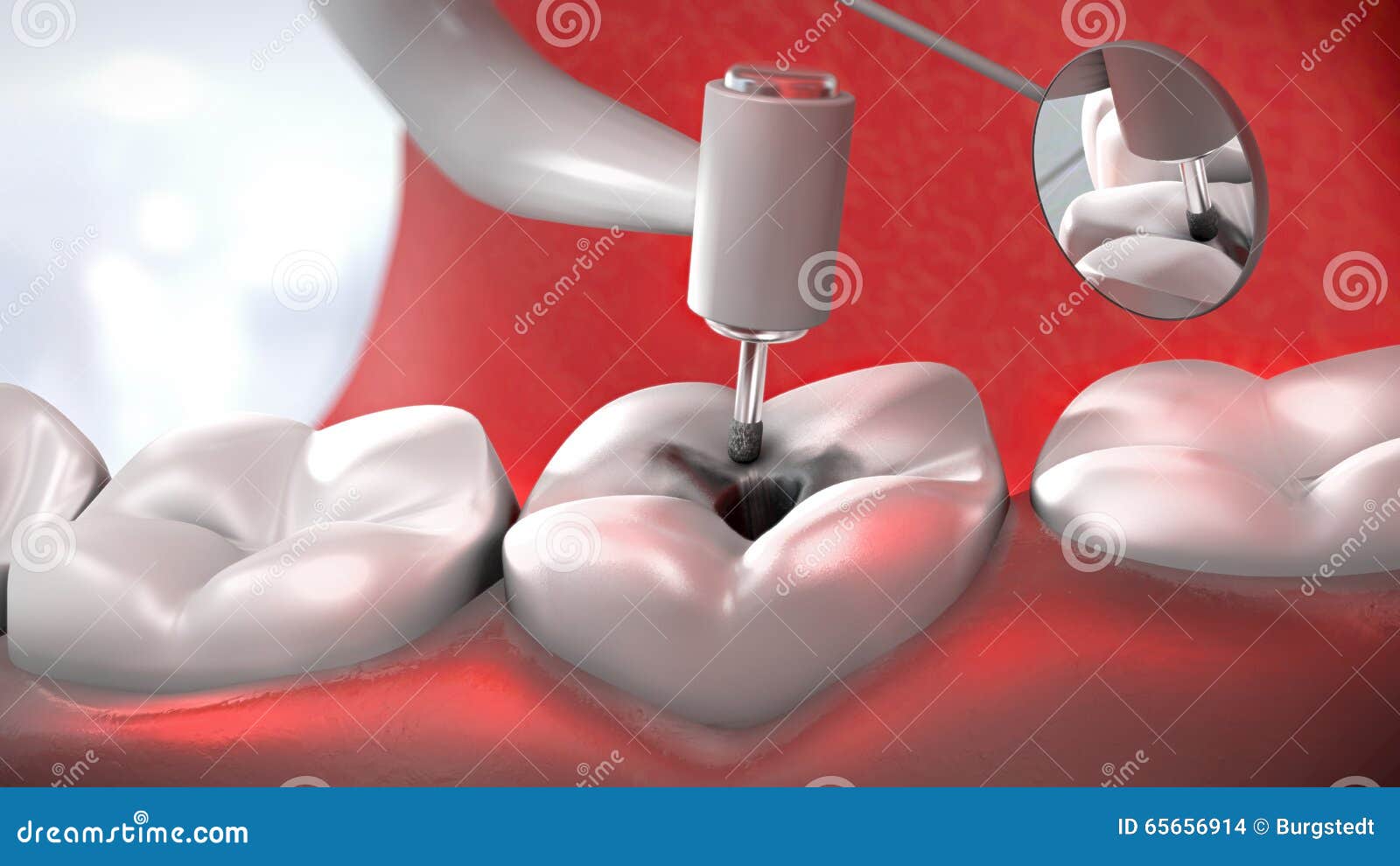 Dentist S Drill Treating a Sick Tooth Stock Illustration Illustration of health, expenses
