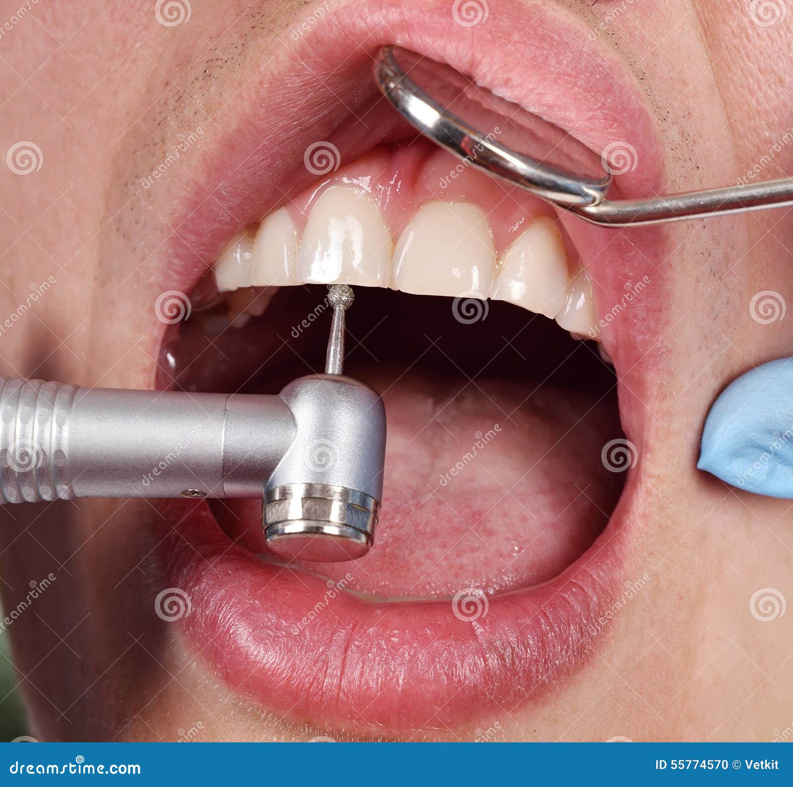 Pinchazo Portal primero Dentista Que Usa El Taladro Dental Foto de archivo - Imagen de  procedimiento, oral: 55774570